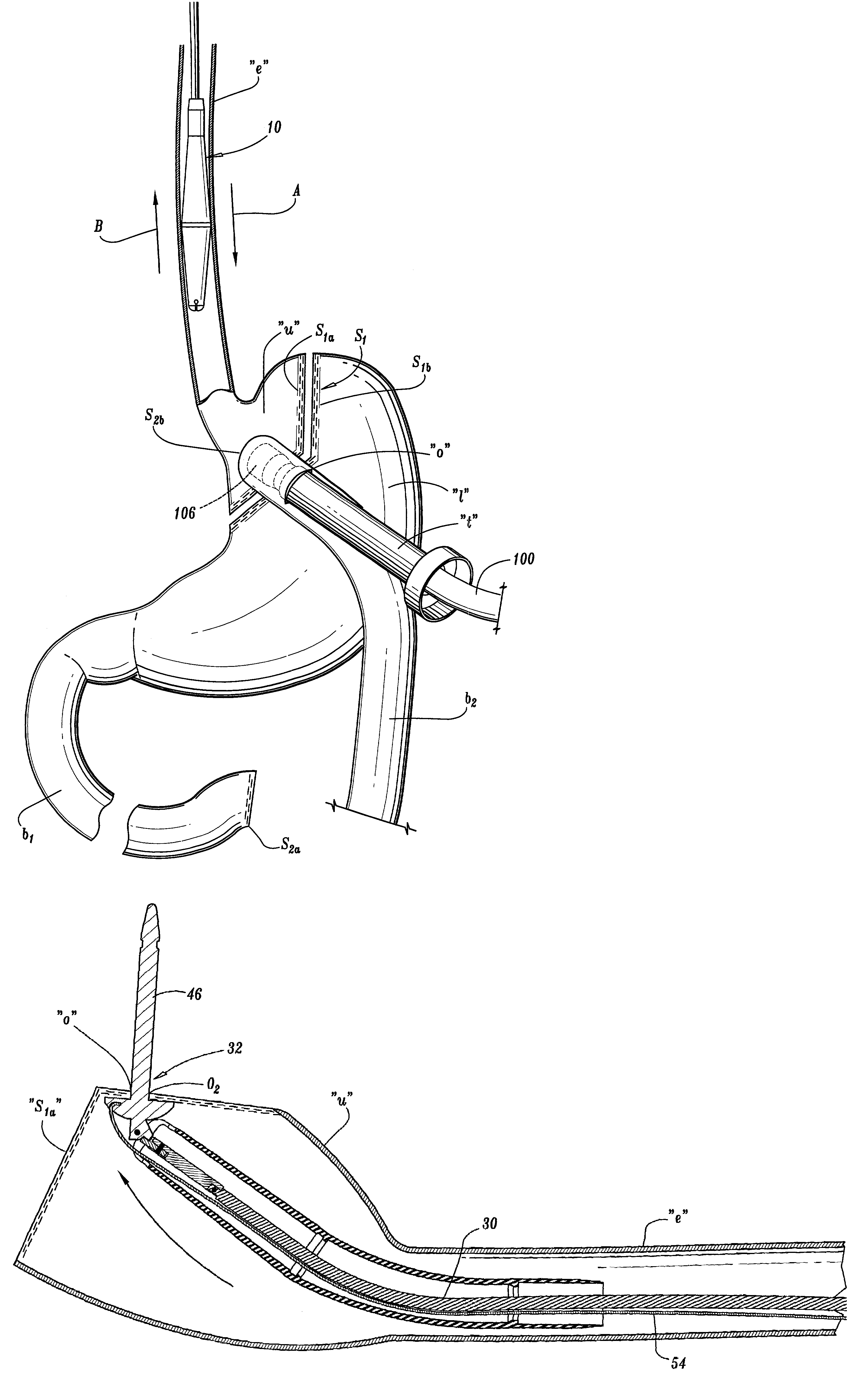 Apparatus and method for performing a bypass procedure in a digestive system