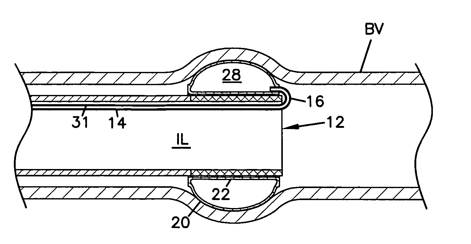 Rapid balloon coupling system