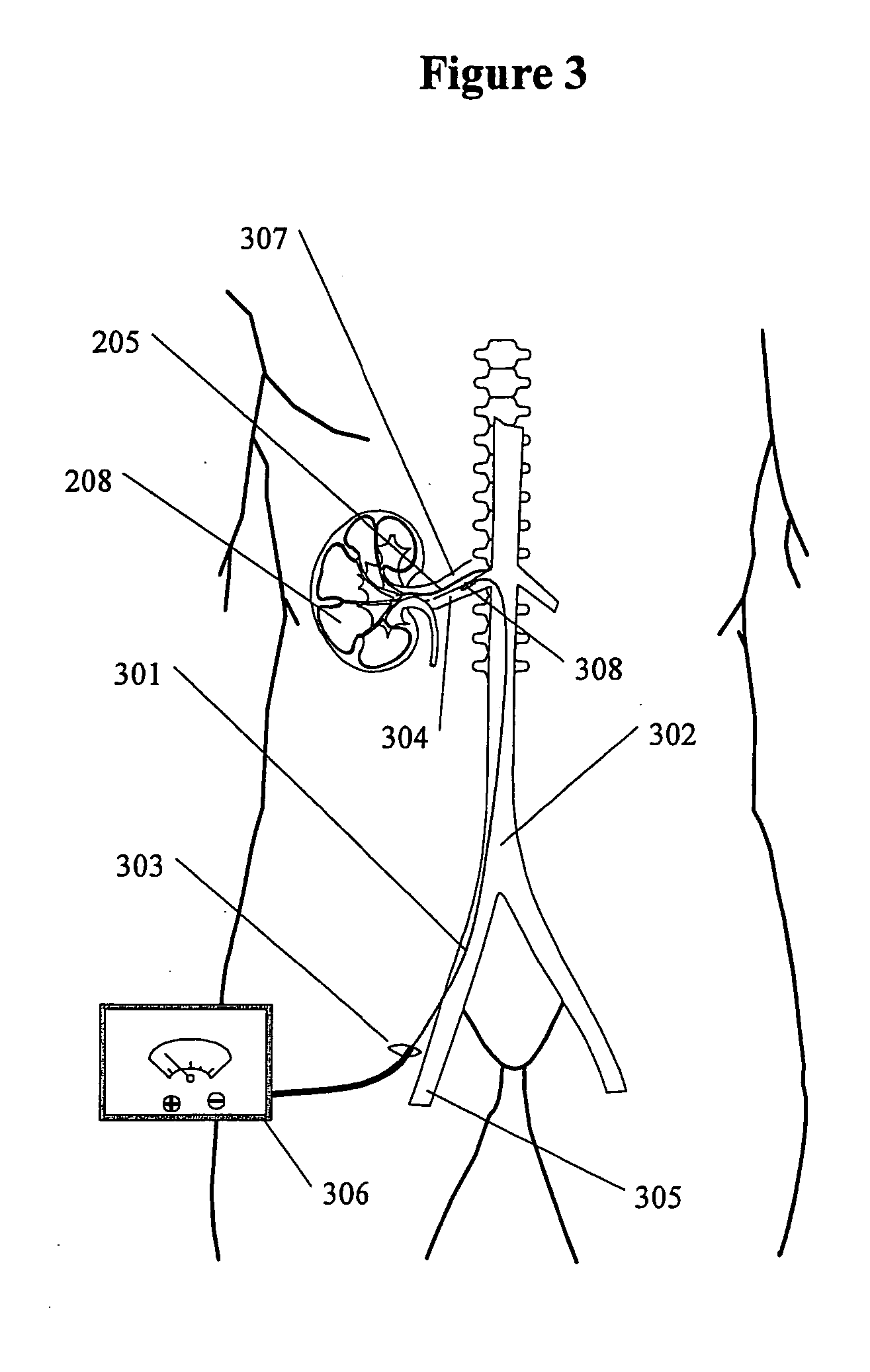Renal nerve stimulation method and apparatus for treatment of patients