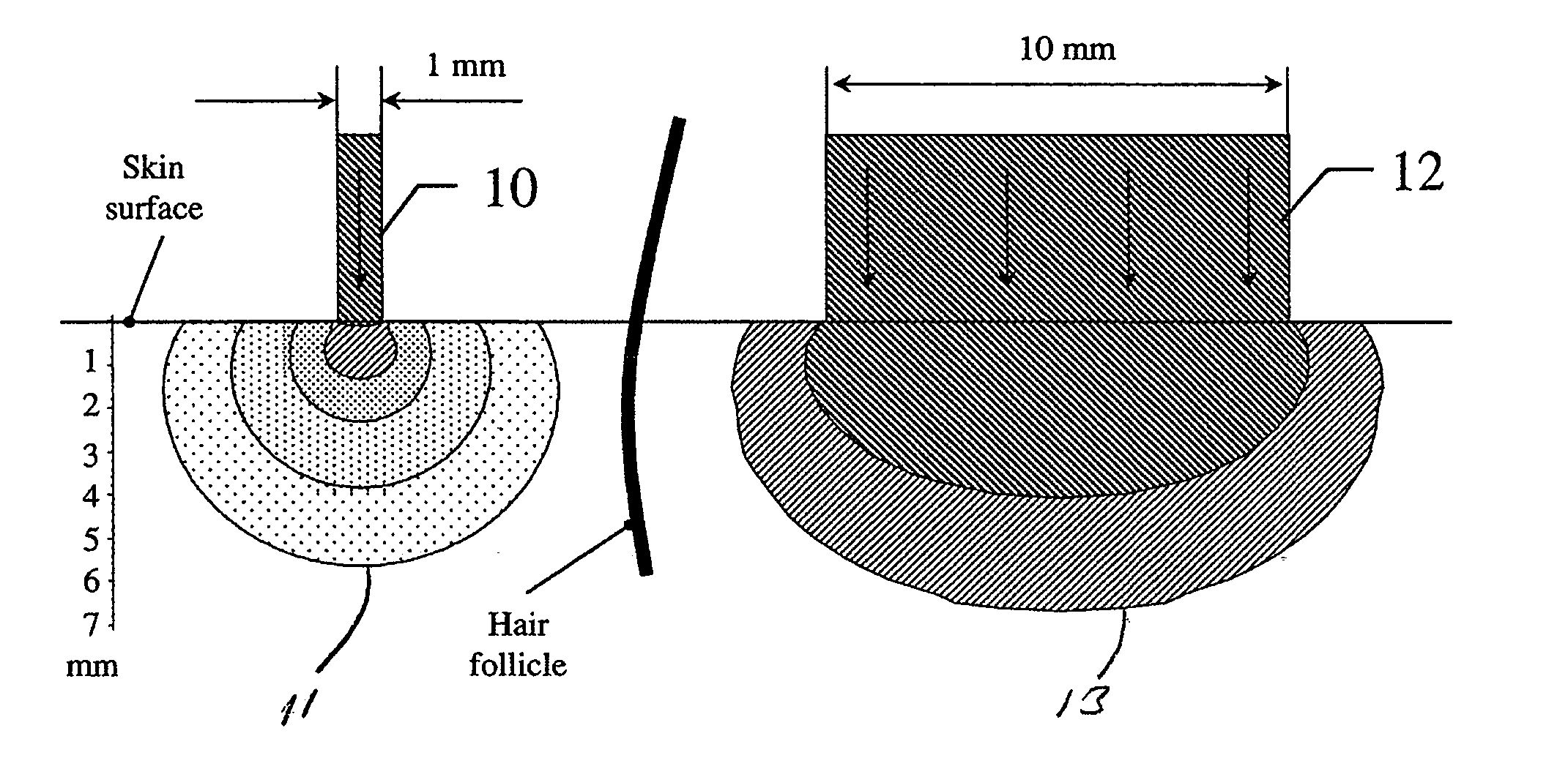 Method and apparatus of treating tissue