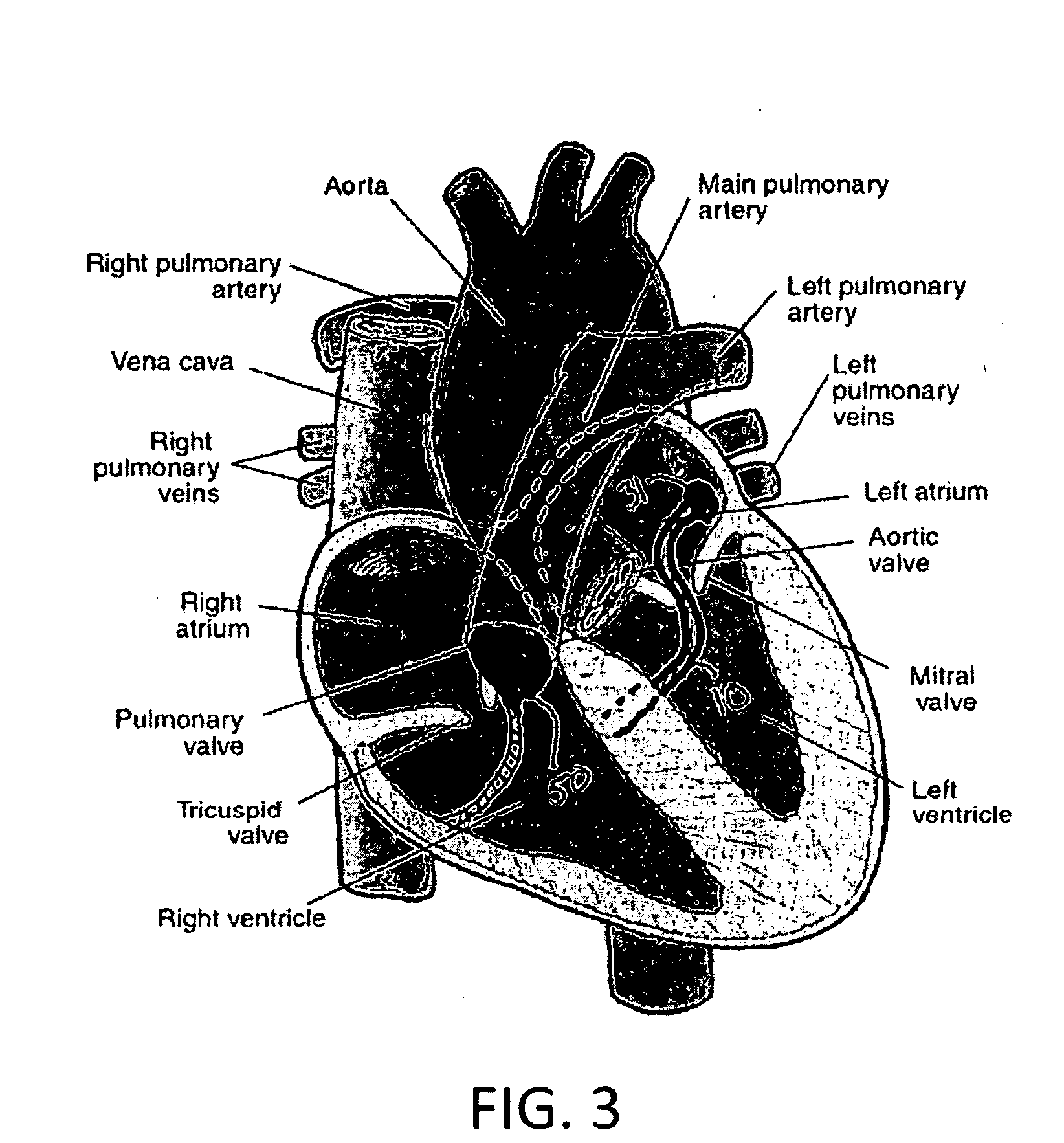Isolation of pulmonary vein
