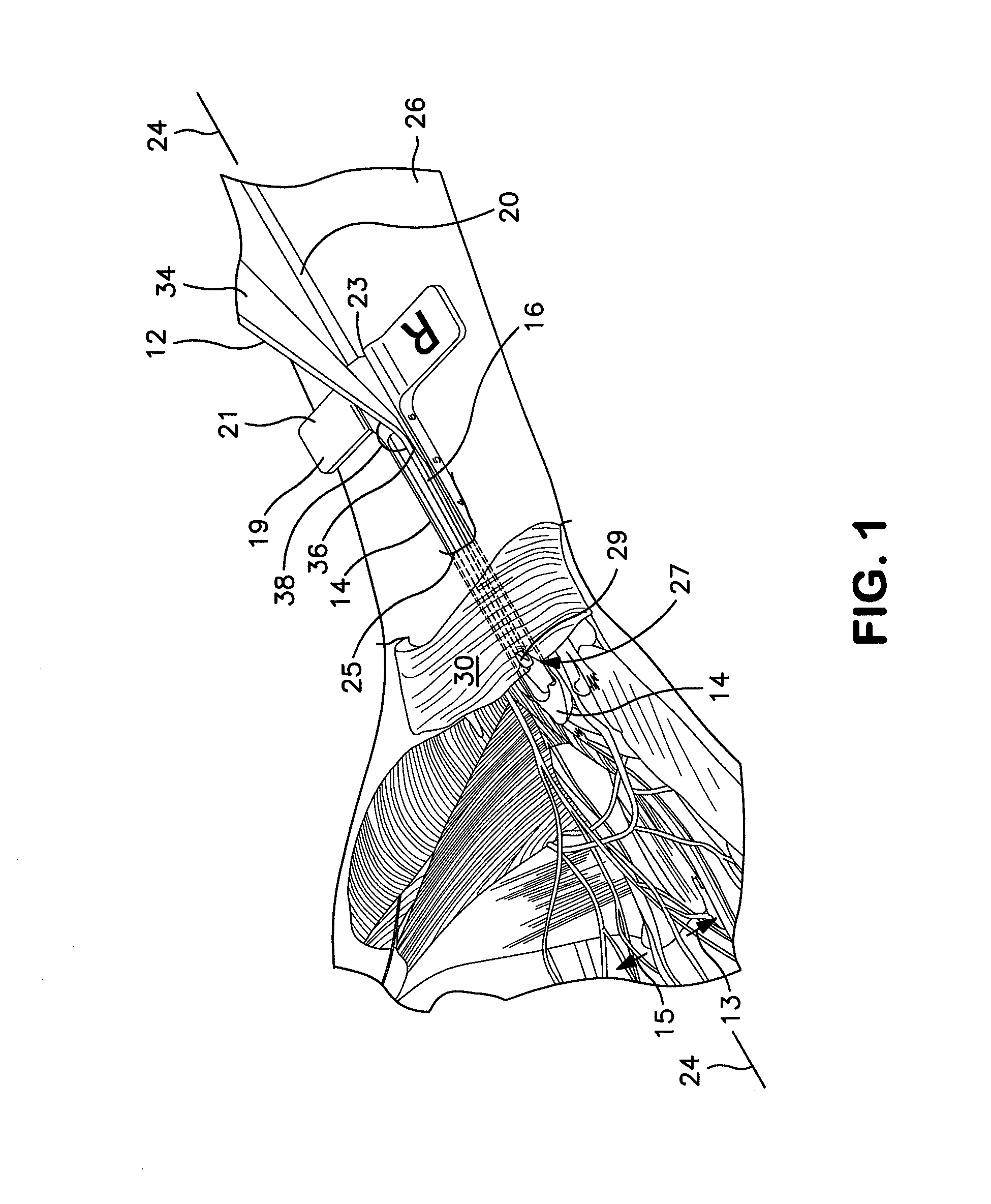 Method and apparatus for endoscopic ligament release