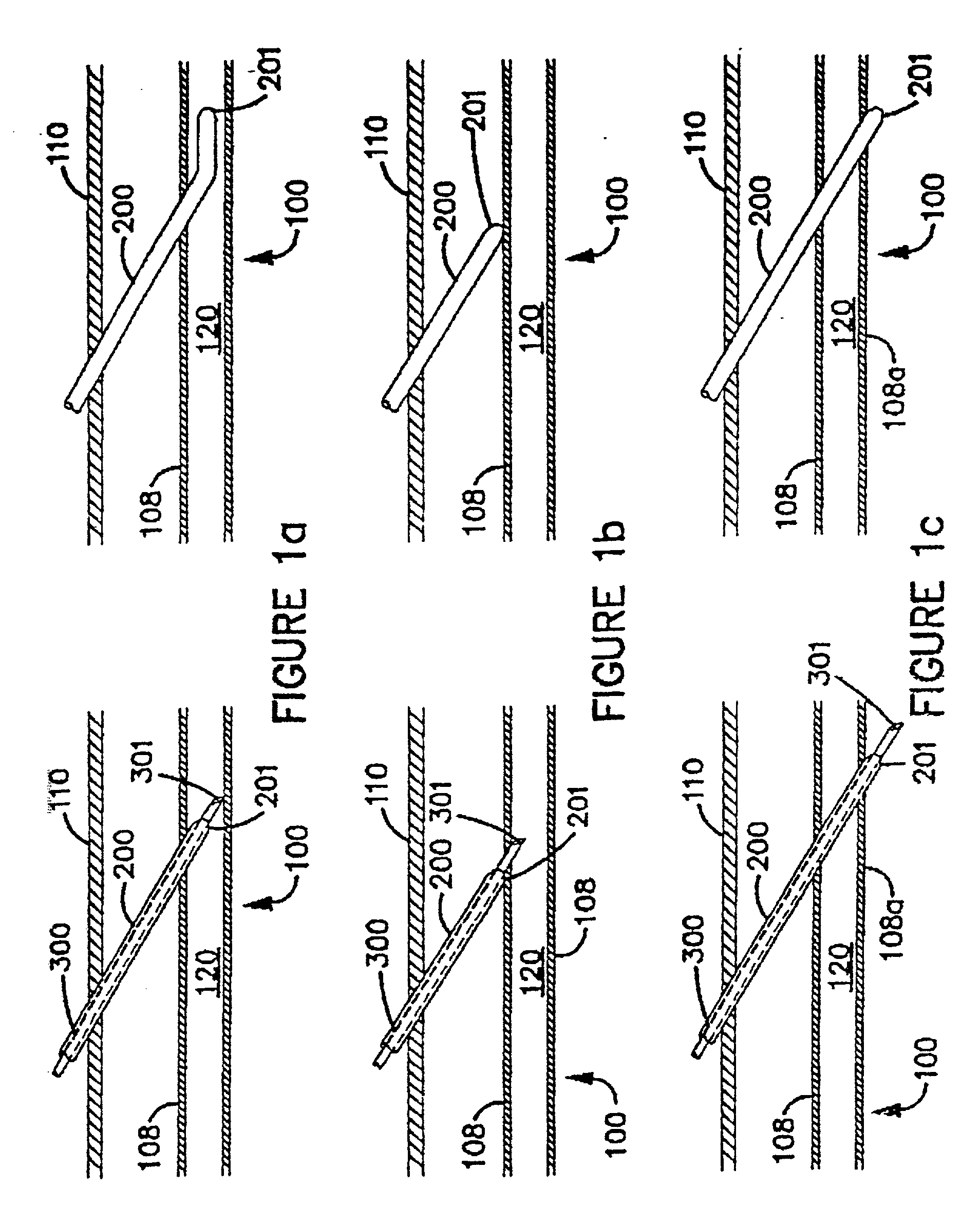 Apparatus and method for catheterization of blood vessels