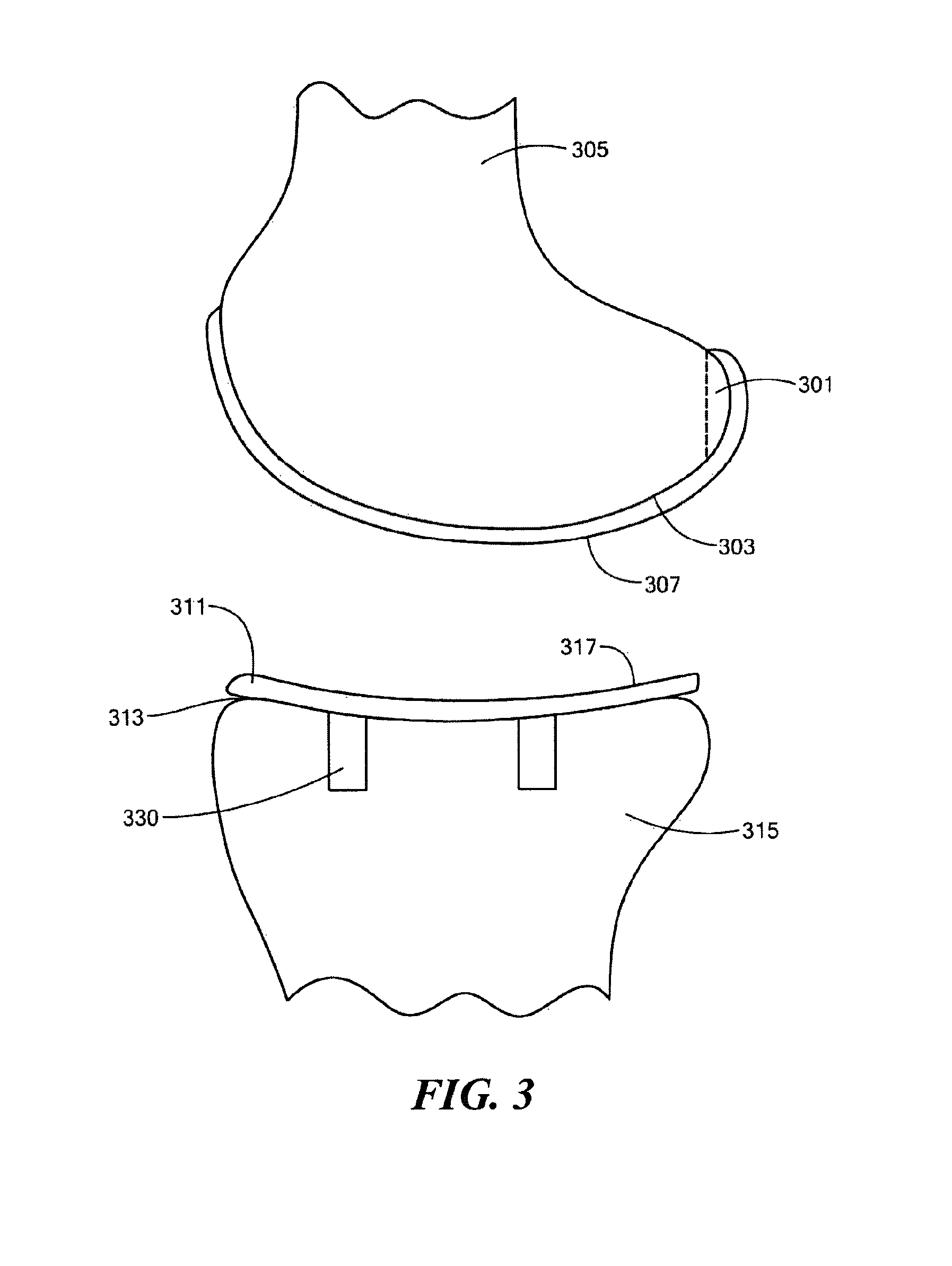 Implant device and method for manufacture