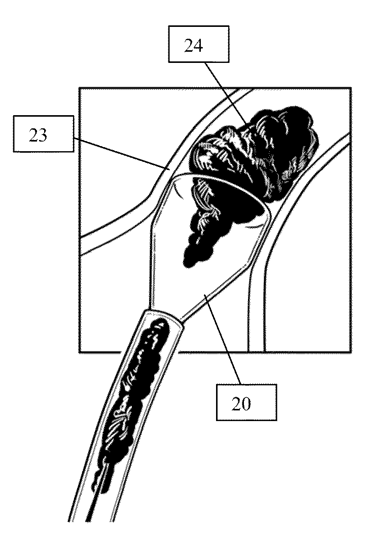 Systems and Methods for Removing Undesirable Material Within a Circulatory System During a Surgical Procedure