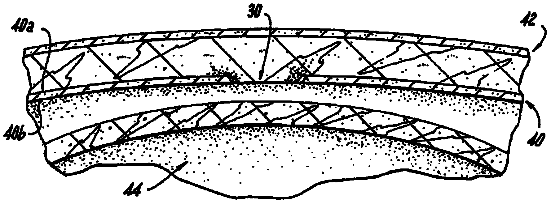 Hernia repair system