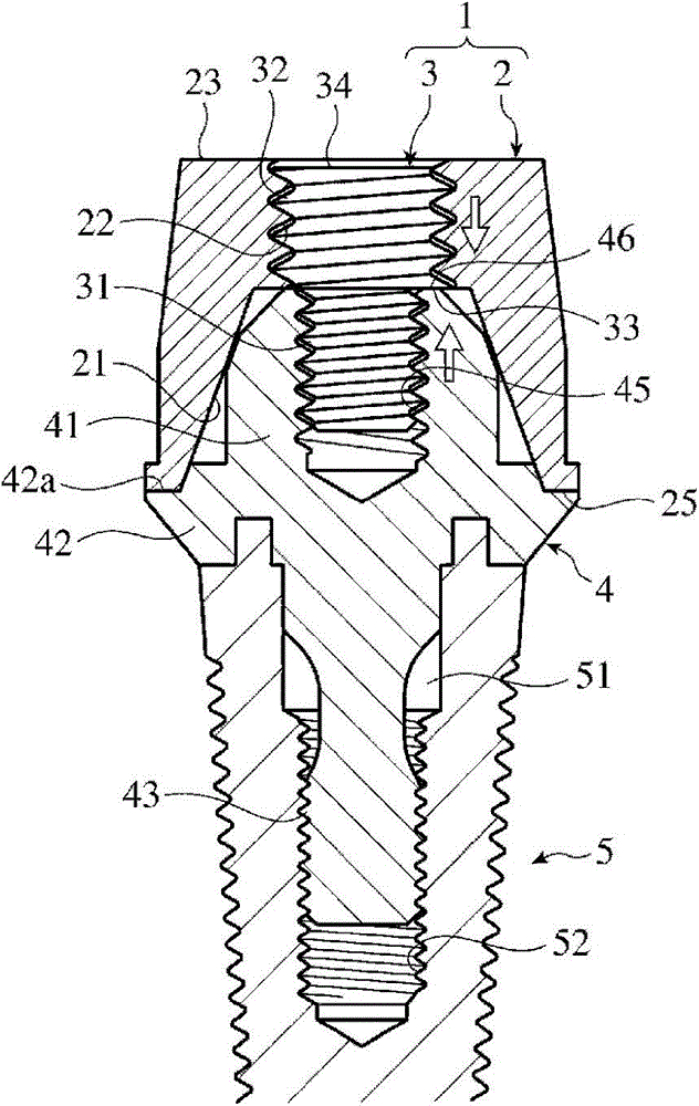 Keeper for implant, assembly thereof, and method for affixing keeper