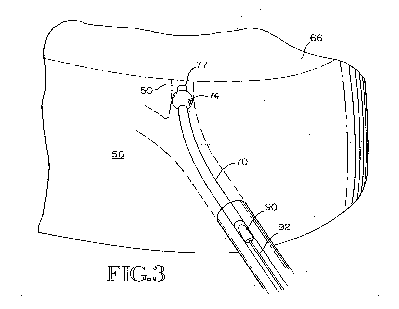 Removable anchored lung volume reduction device and methods
