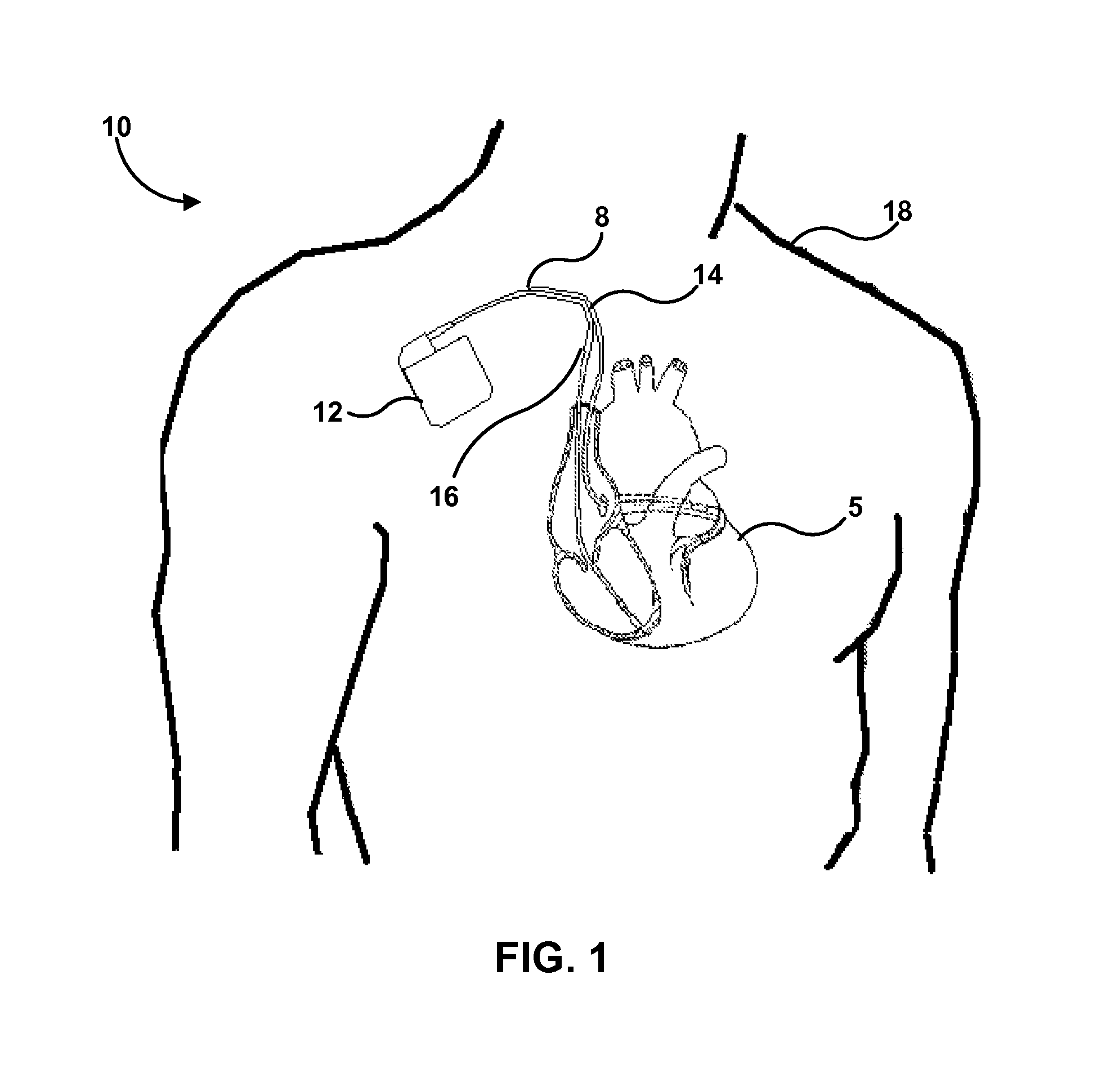 Implantable medical lead with biased electrode