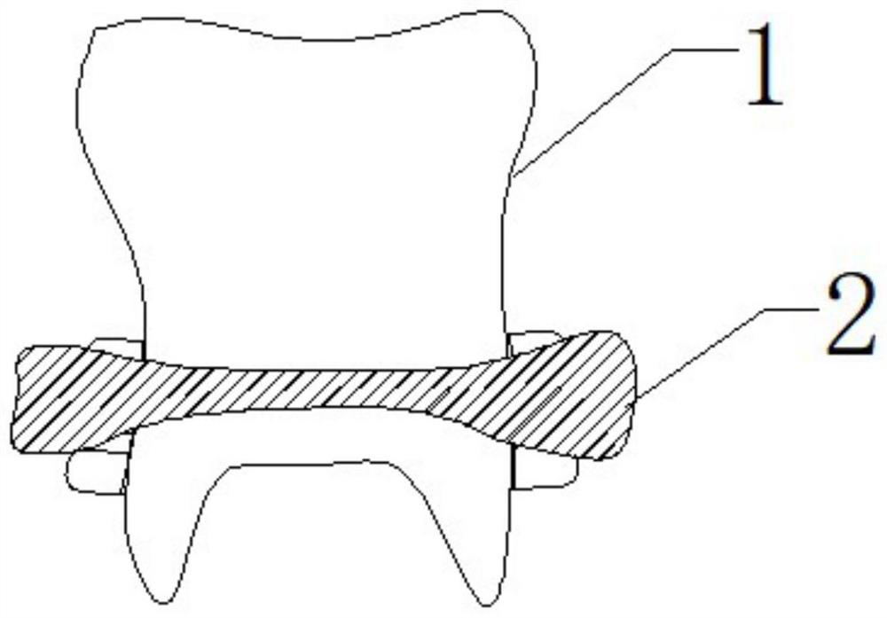 Copper sheet and activated carbon combined high-elasticity invisible removable denture