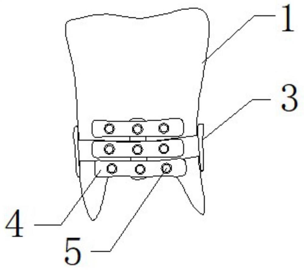 Copper sheet and activated carbon combined high-elasticity invisible removable denture