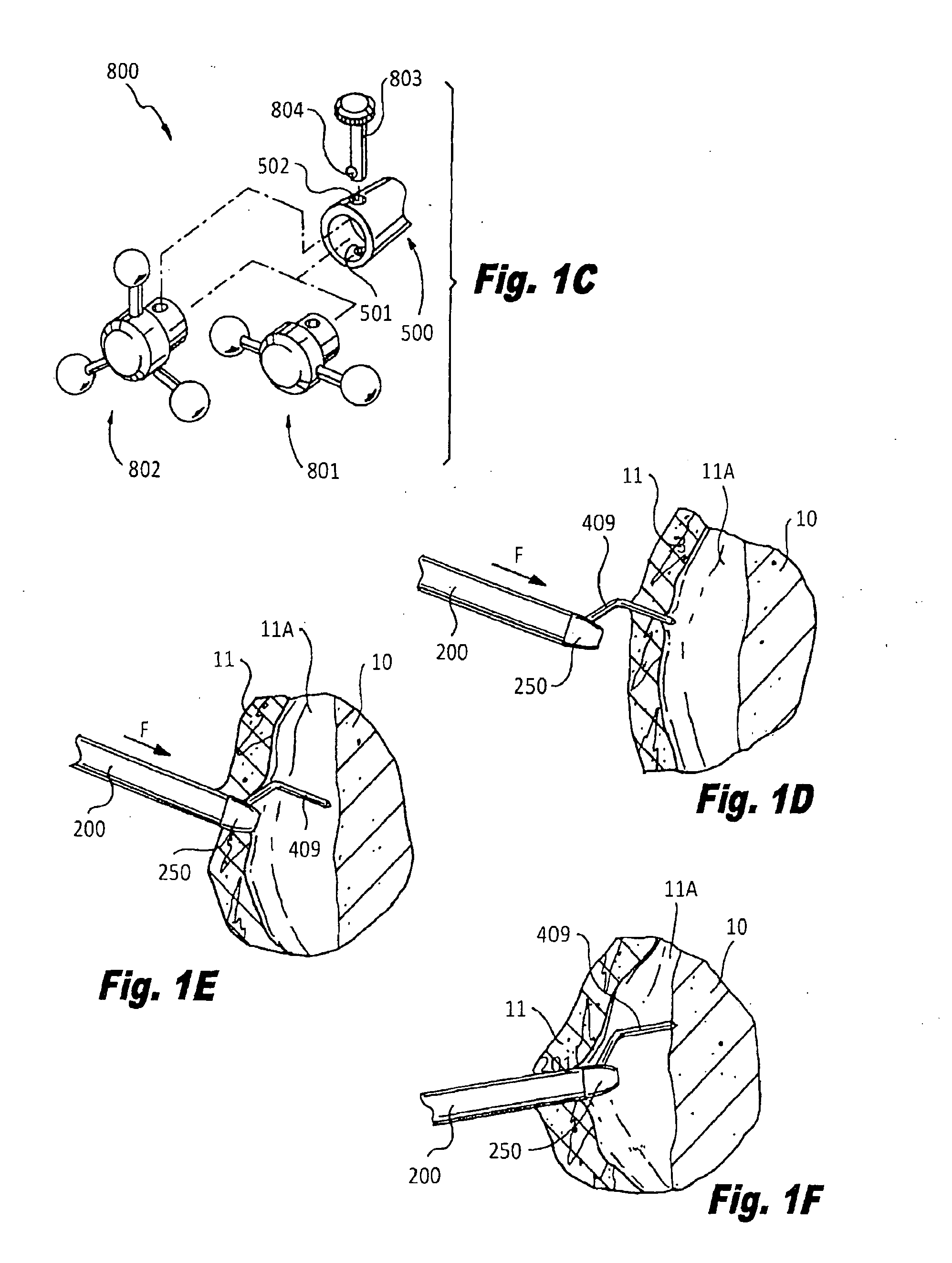 Cannulated apparatus and method relating to microfracture and revascularization methodologies