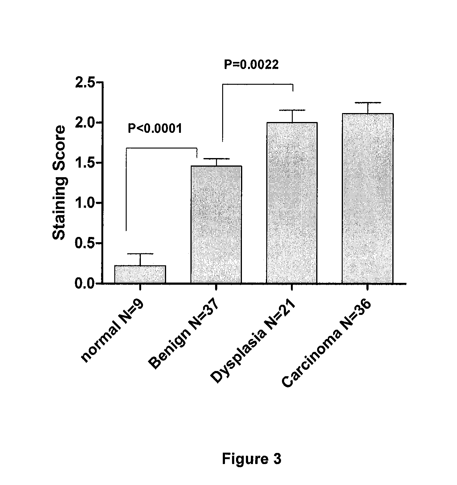 G-protein coupled receptor-associated sorting protein 1 as a cancer biomarker