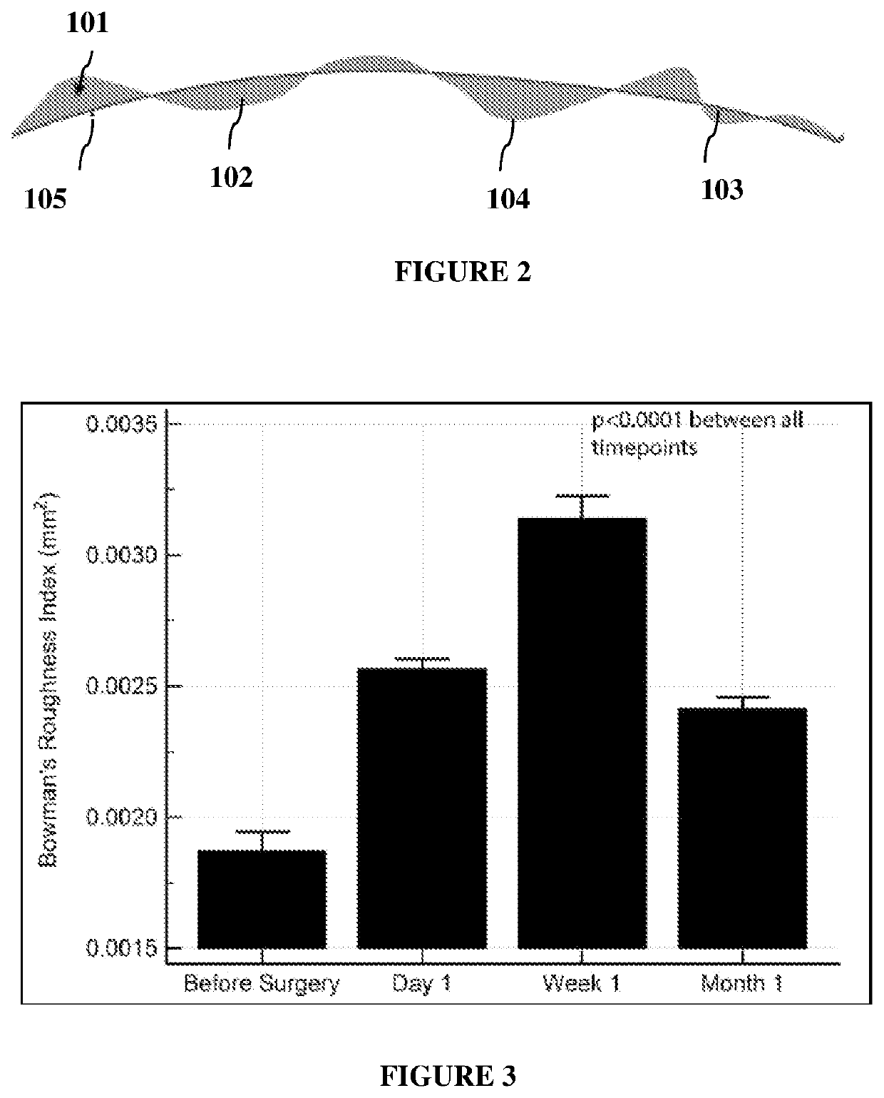 Index for quanitification of bowman's layer roughness for diagnosis of disease and prognosis of treatments in human cornea