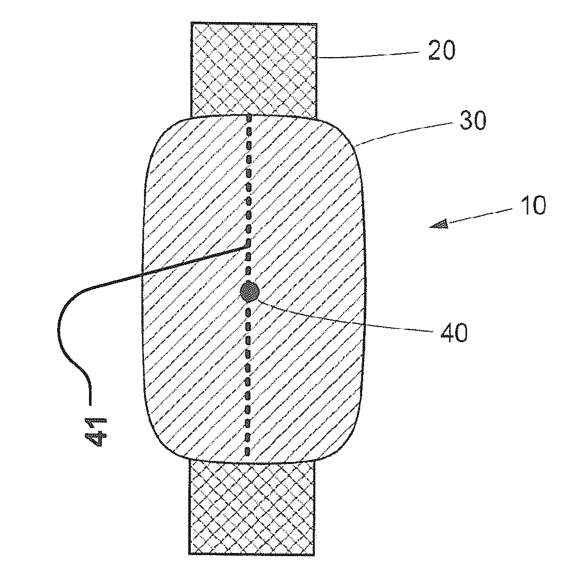Device And Method For Closure Of A Body Lumen