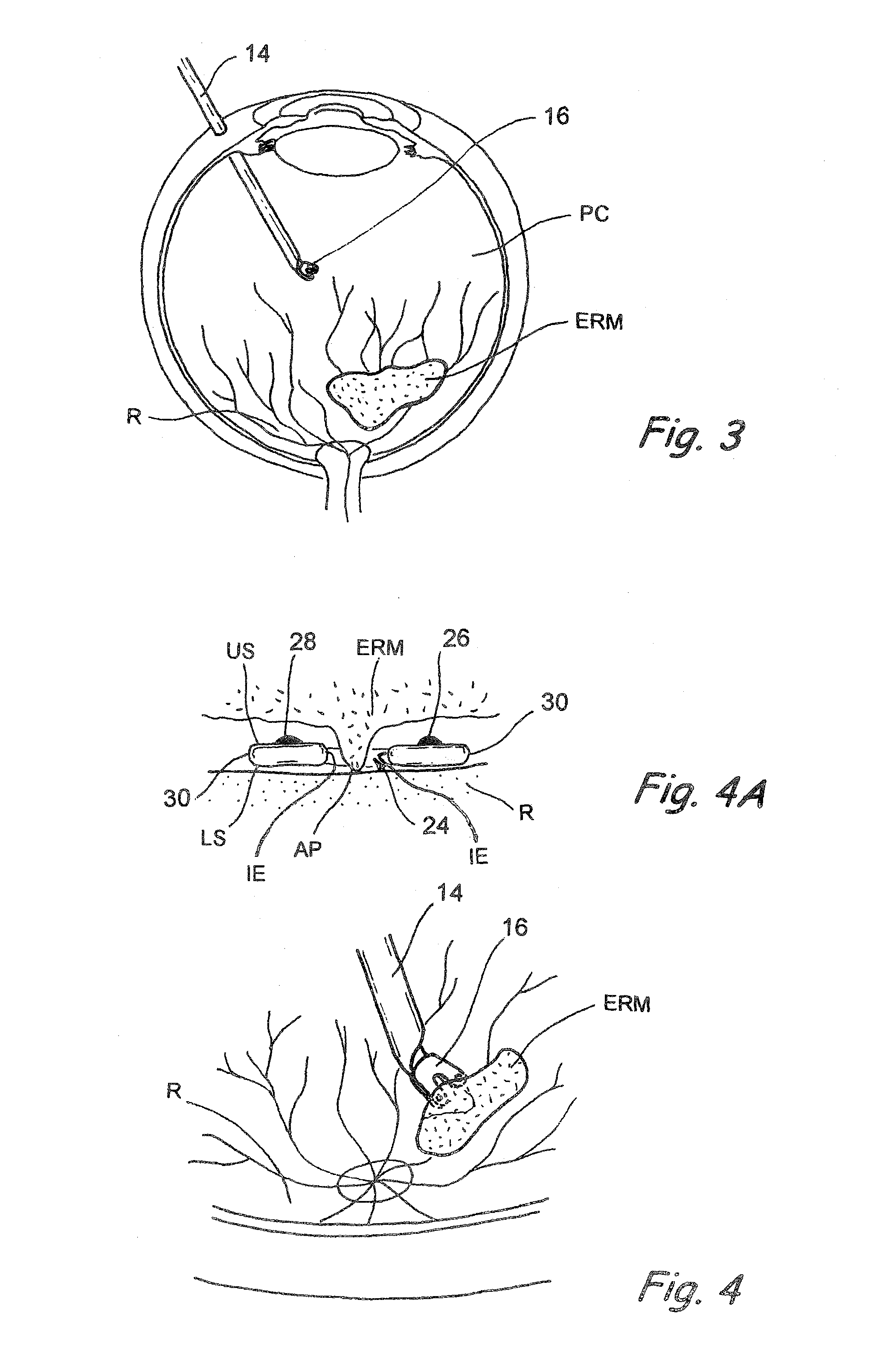 Electrosurgical devices and methods for selective cutting of tissue