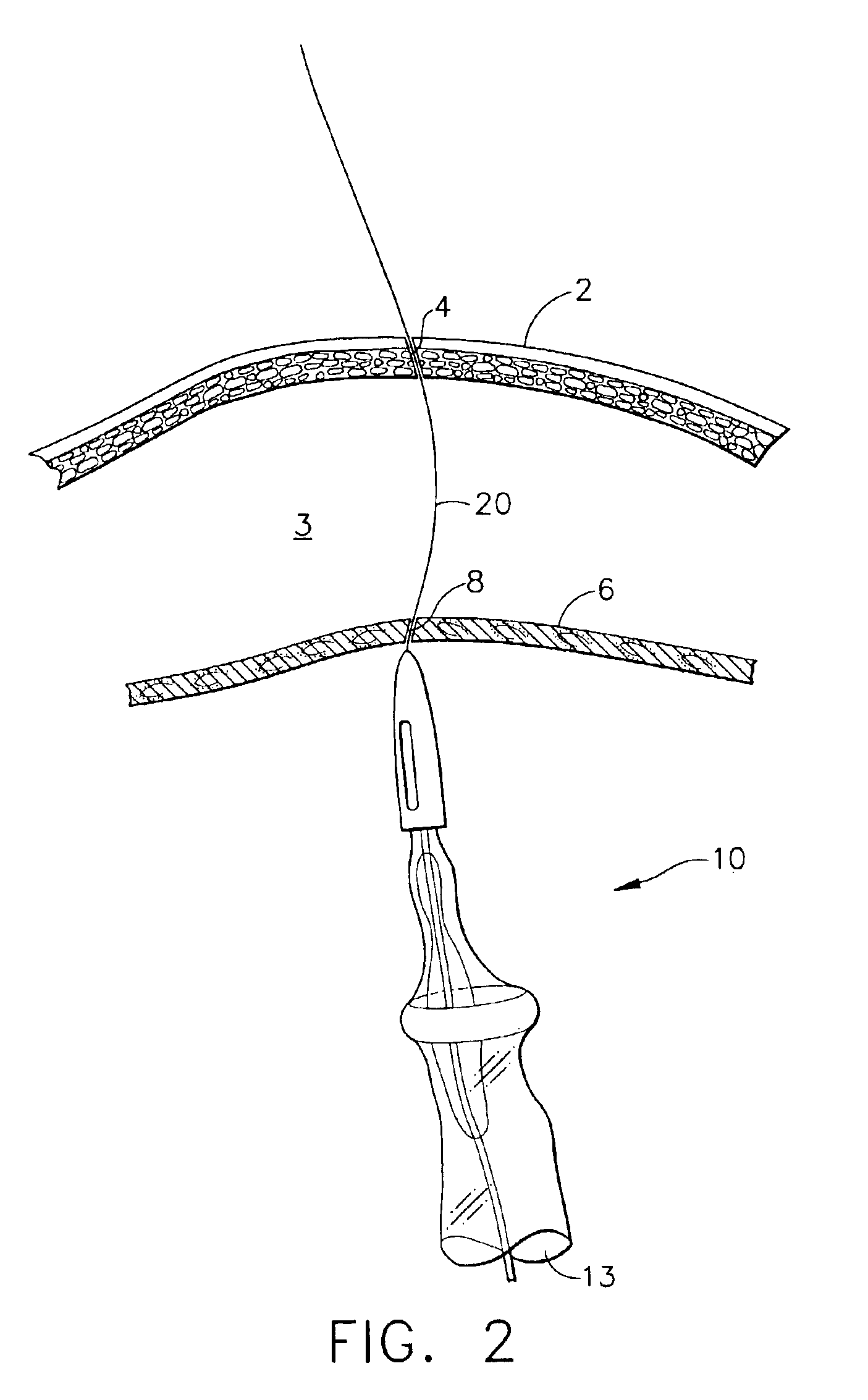 Method for accessing cavity