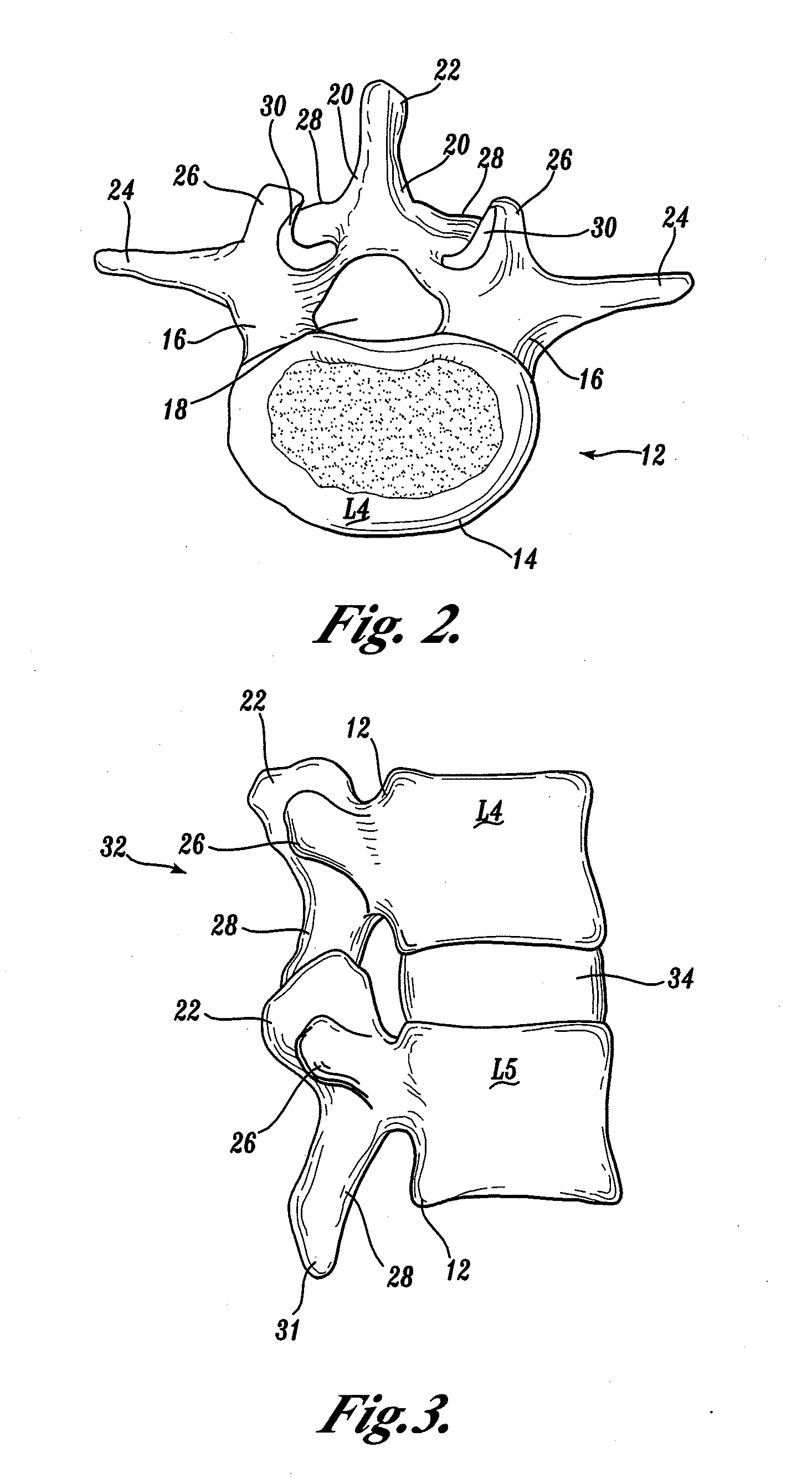 Polyaxial adjustment of facet joint prostheses