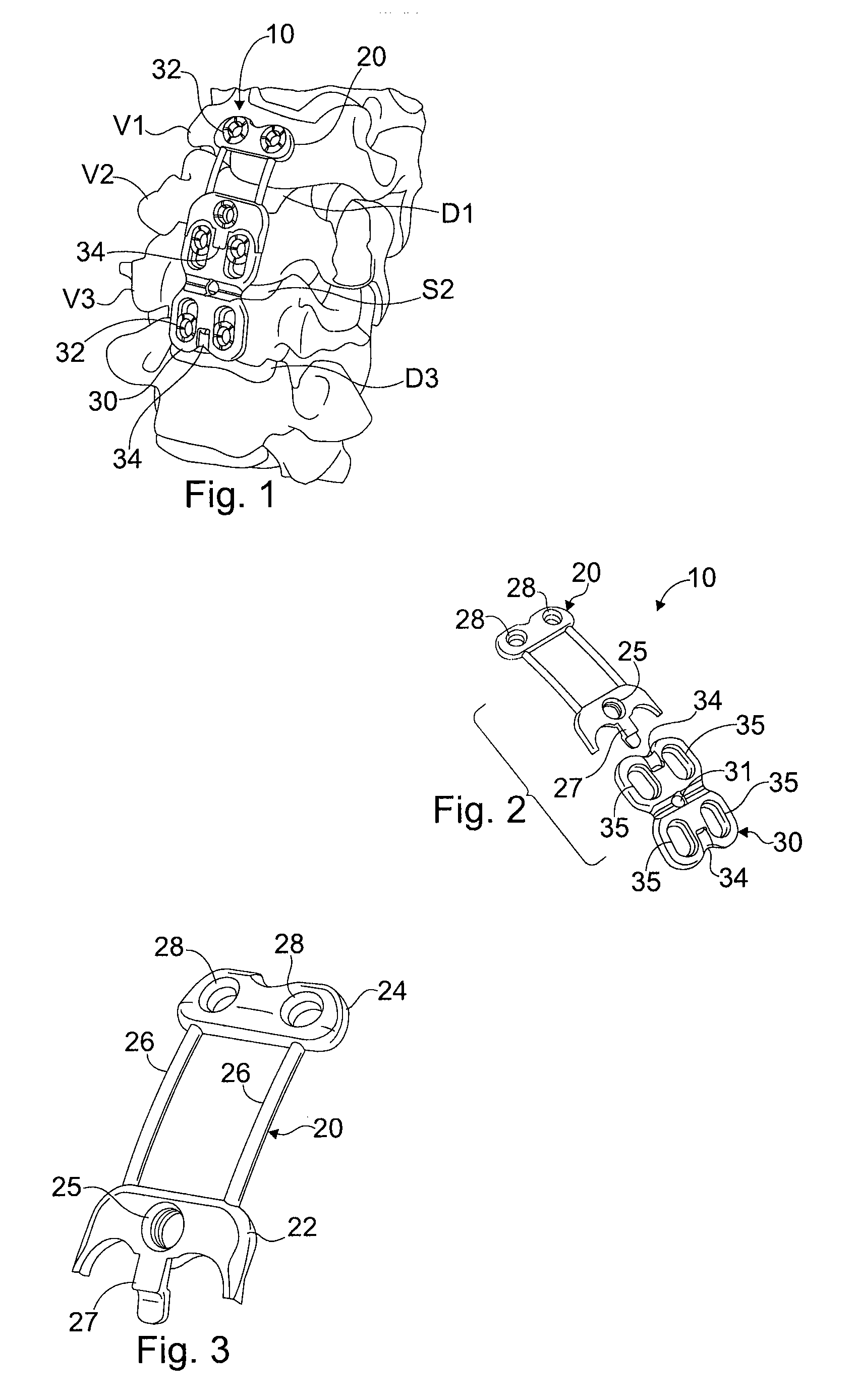 Dynamic extension plate for anterior cervical fusion and method of installation