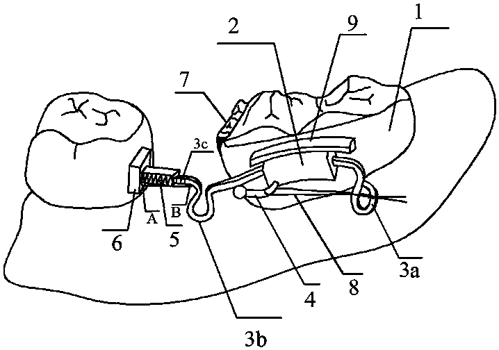 Preparation method of a restoration device for early loss of space between children's replacement dentition