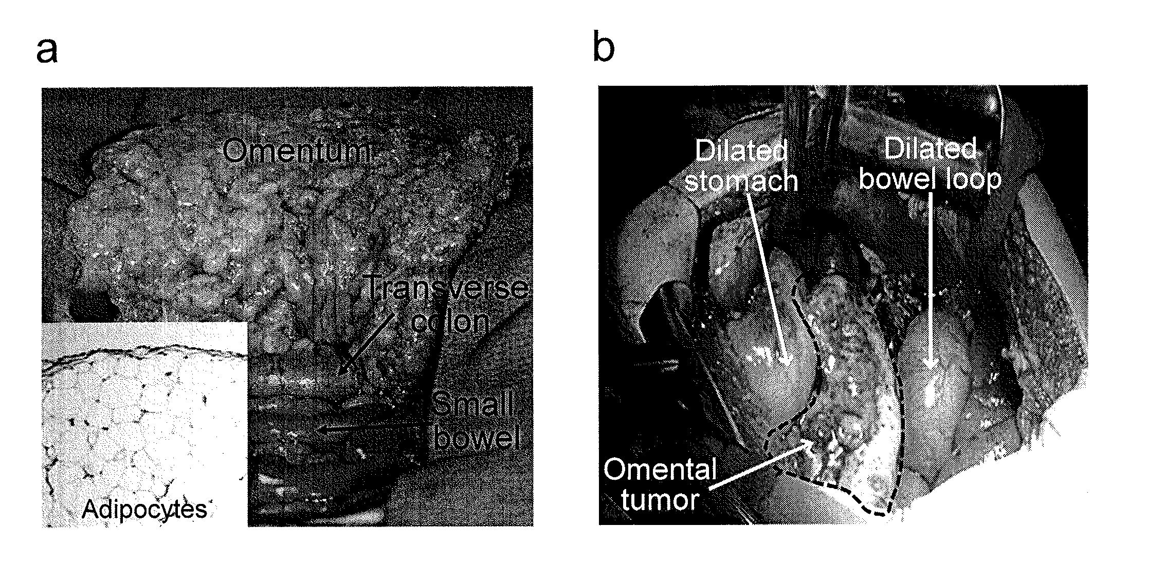 Methods for treating ovarian cancer by inhibiting fatty acid binding proteins