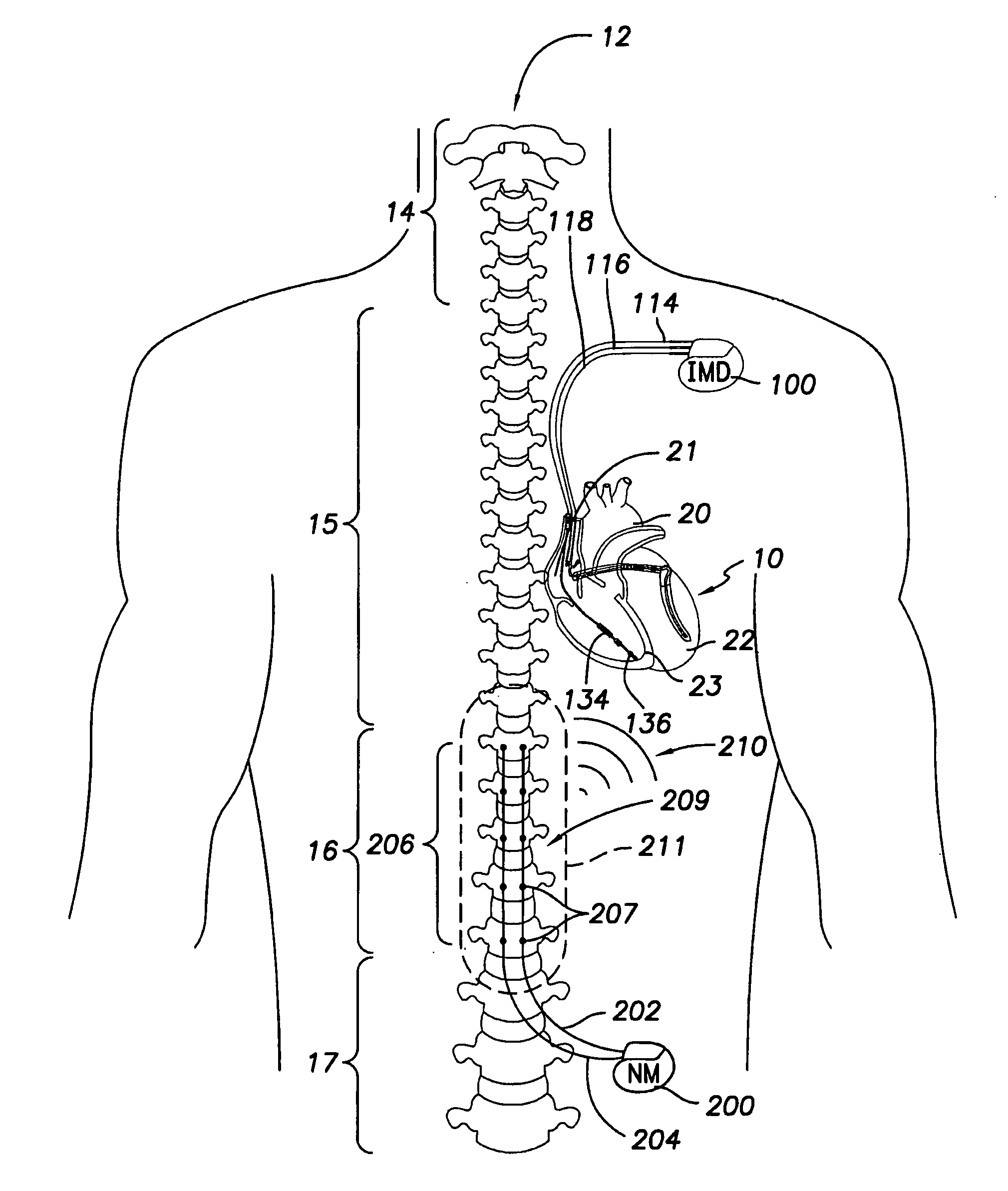 Neurostimulation device and methods for controlling same