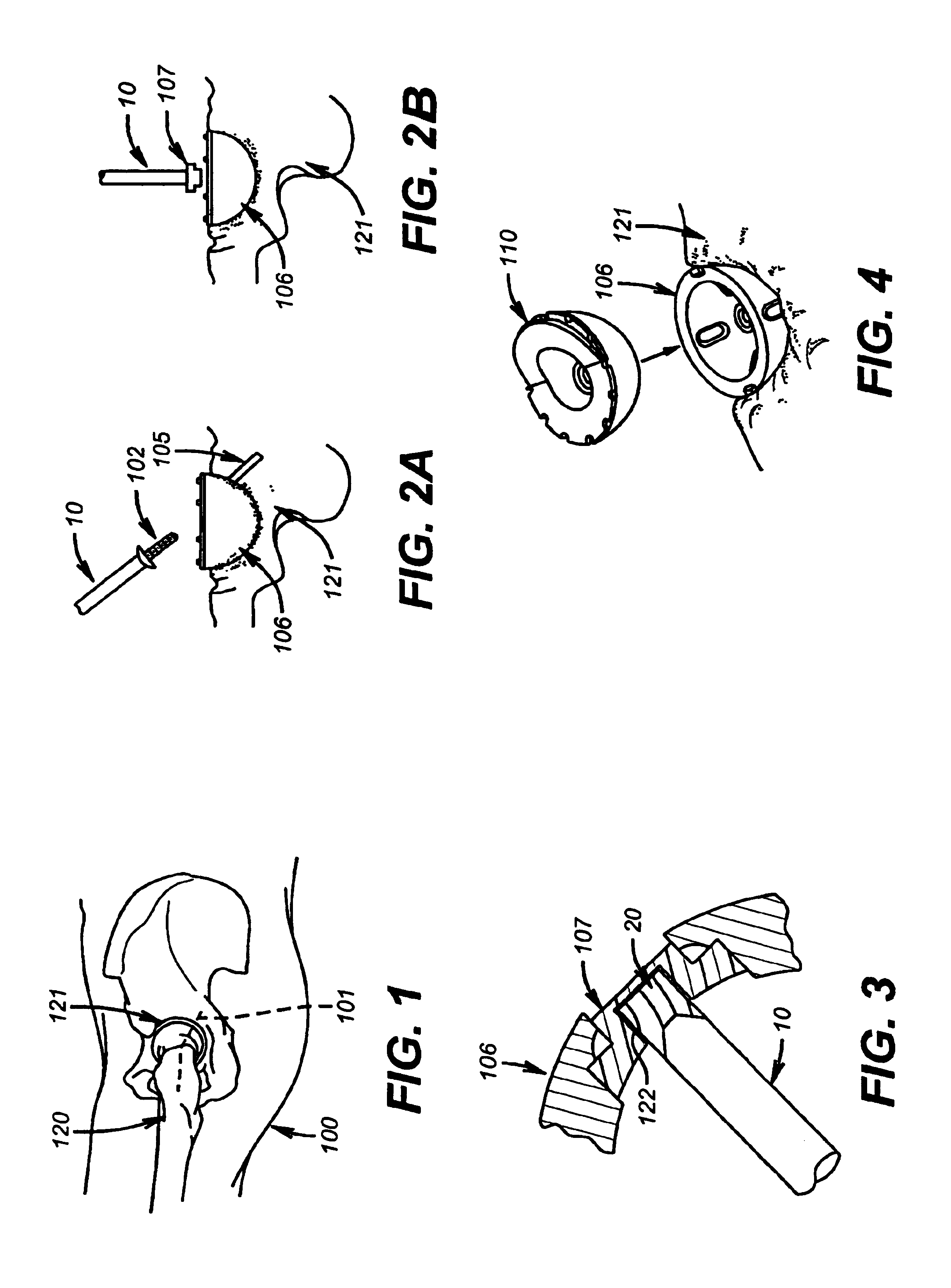 Elongated driving bit attachable to a driving instrument and method of use for minimally invasive hip surgery