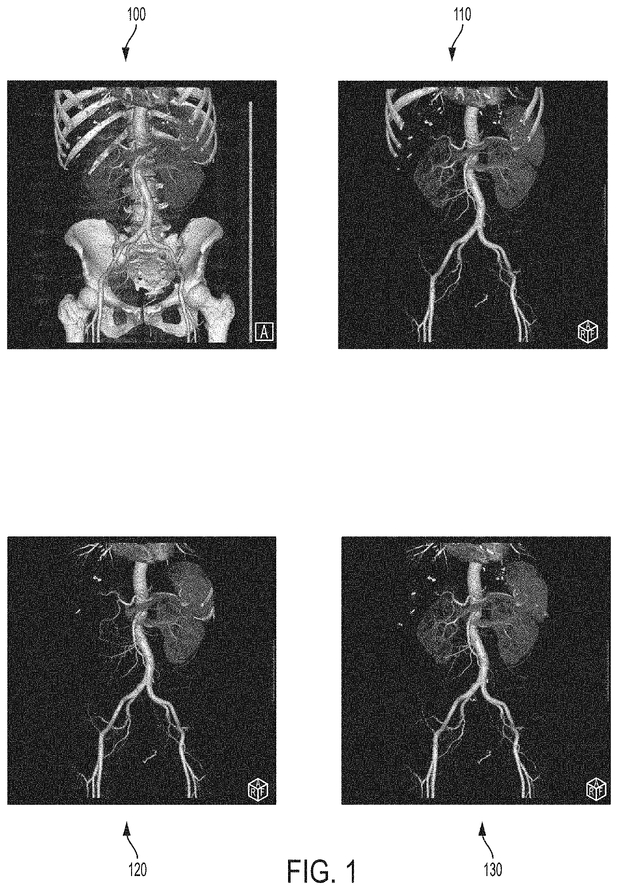 Deep learning based bone removal in computed tomography angiography