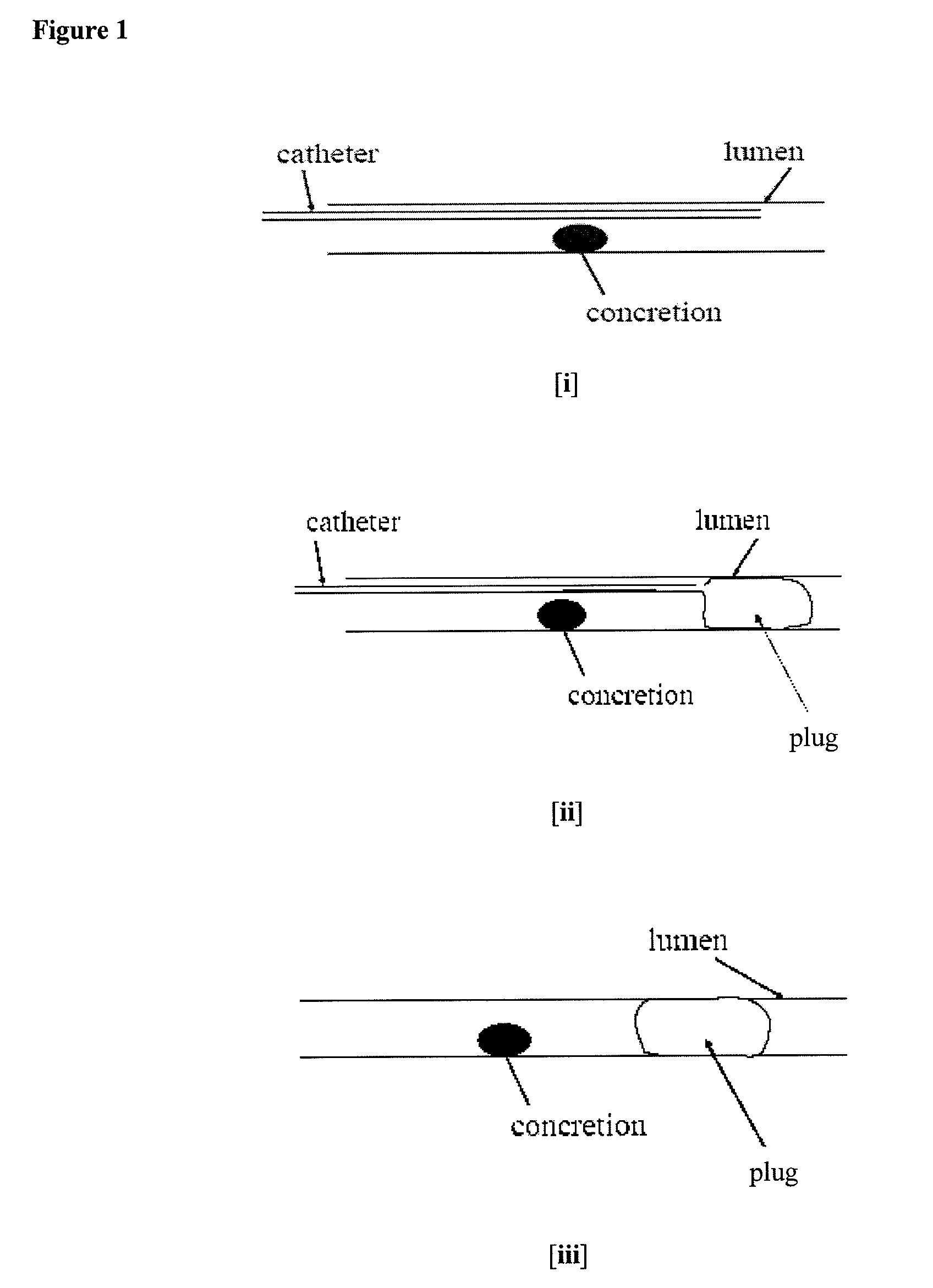 Methods for Preventing Retropulsion of Concretions and Fragments During Lithotripsy