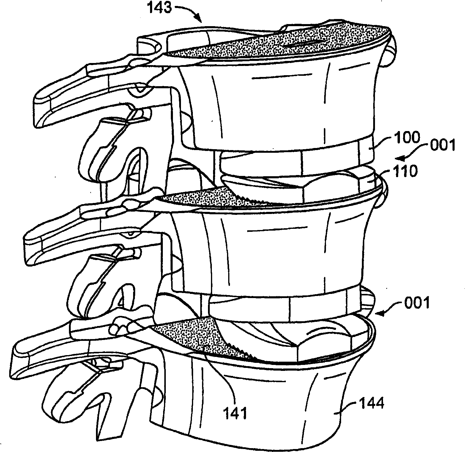 Systems and methods for sizing, inserting and securing an implant intervertebral space