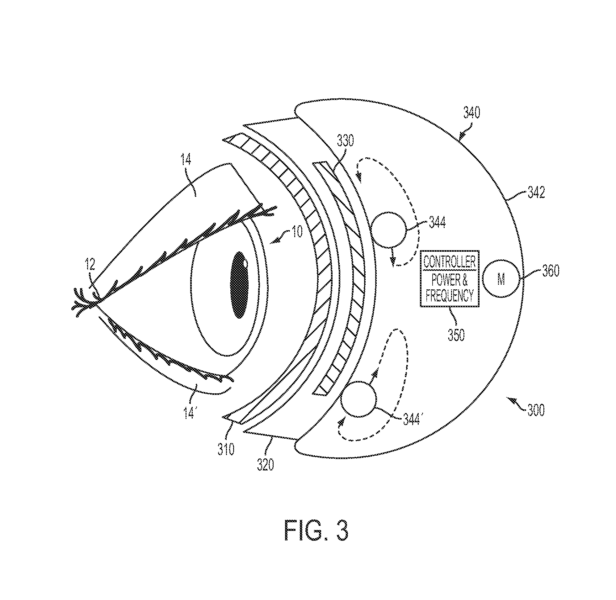 Systems, devices, kits and methods for therapy of the eye