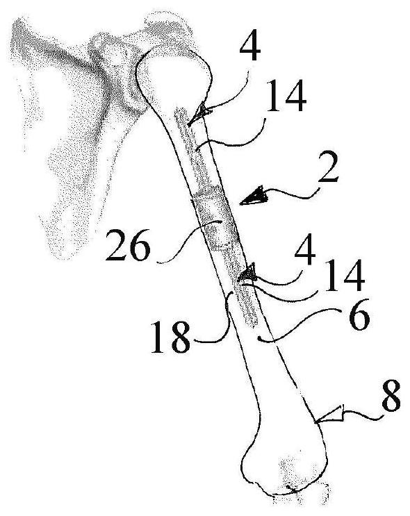 Binder retention implant standle for