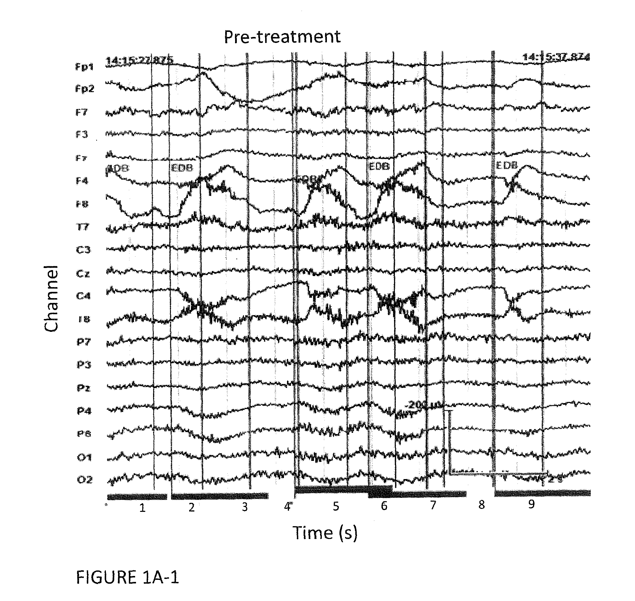 Autoimmune-Induced Glutamatergic Receptor Dysfunction Methods and Treatments