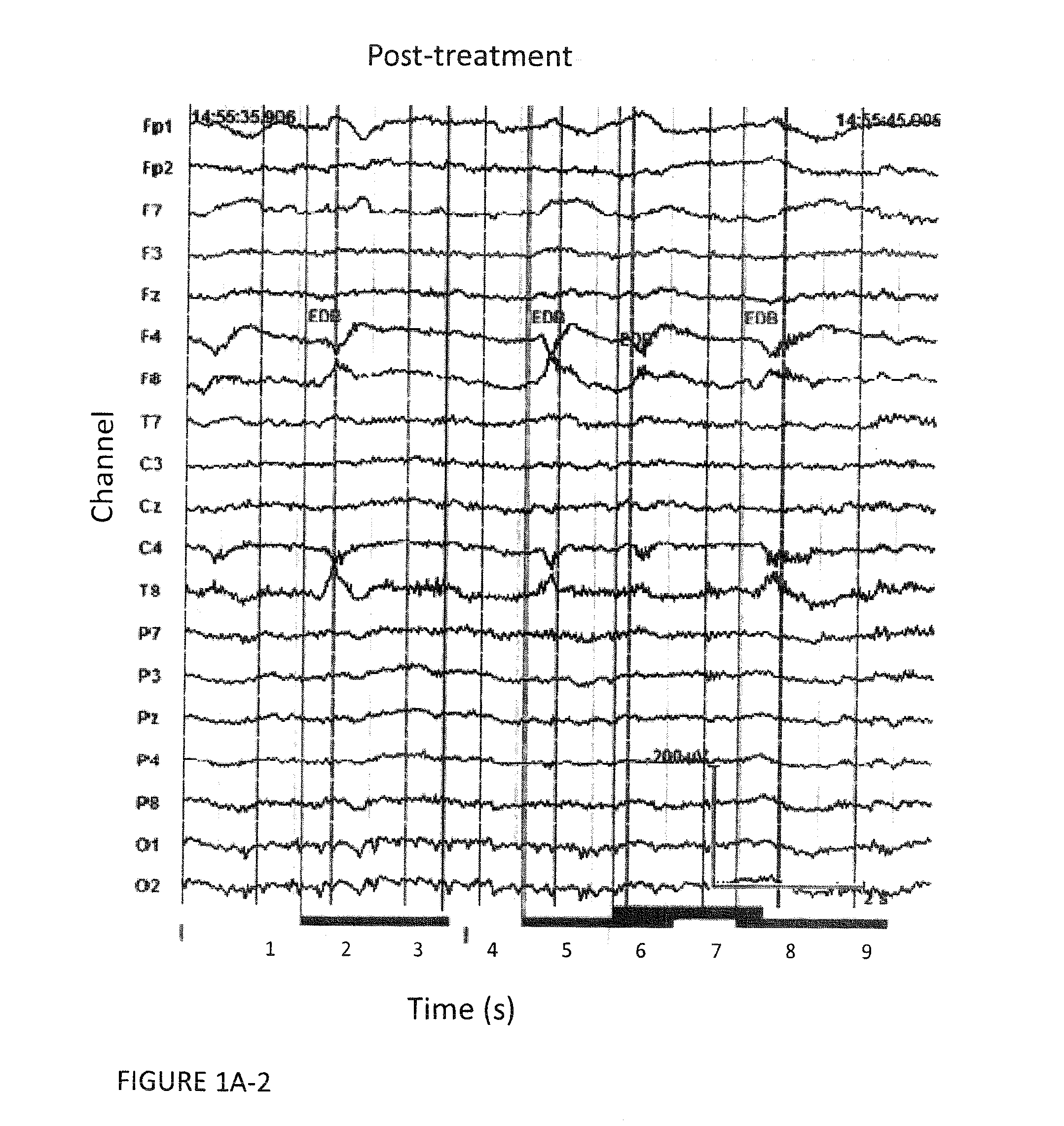 Autoimmune-Induced Glutamatergic Receptor Dysfunction Methods and Treatments