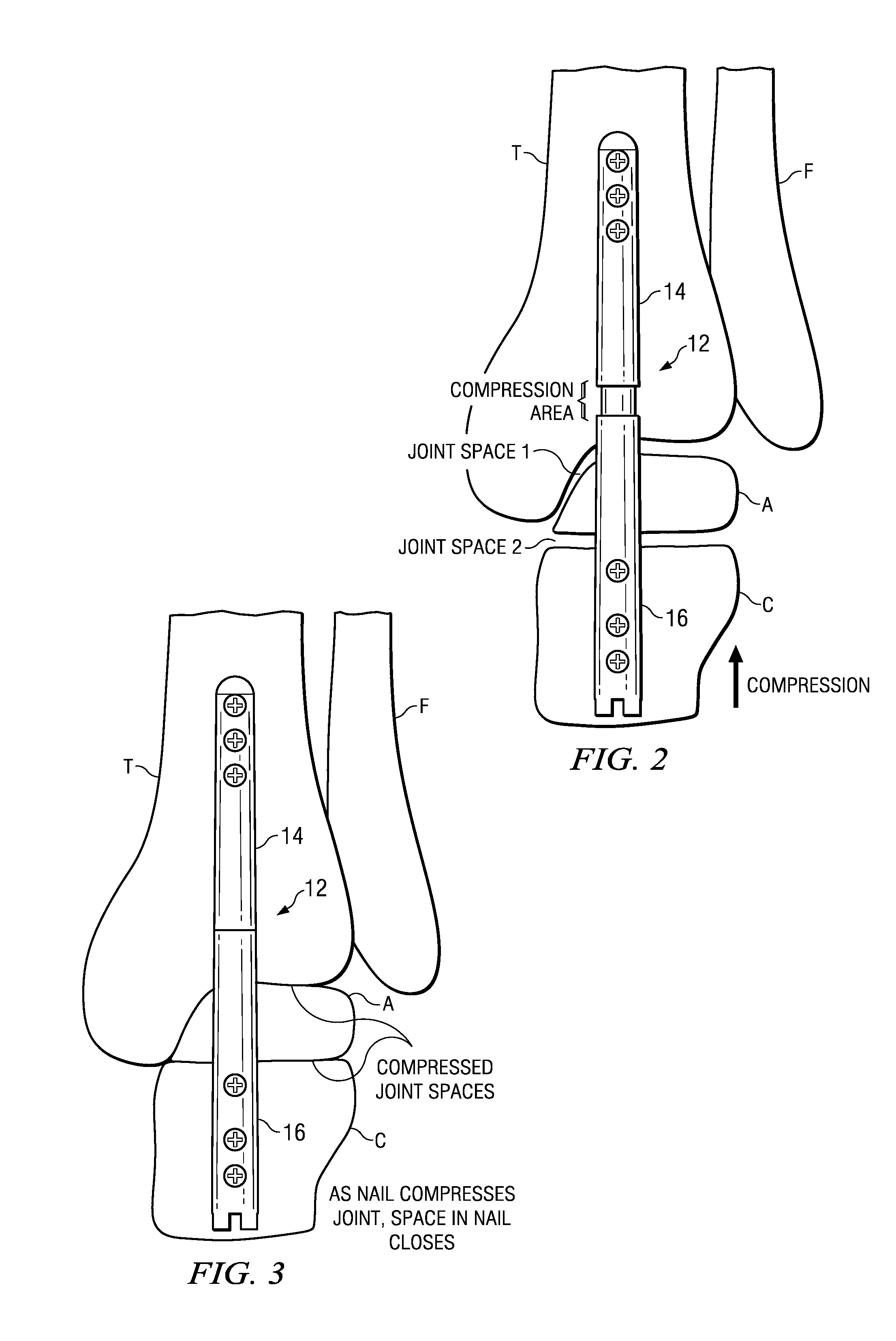 Ankle arthrodesis nail and outrigger assembly