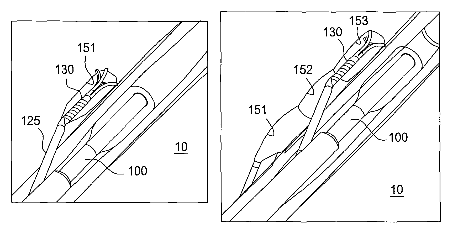 Apparatus and method for prostatic tissue removal