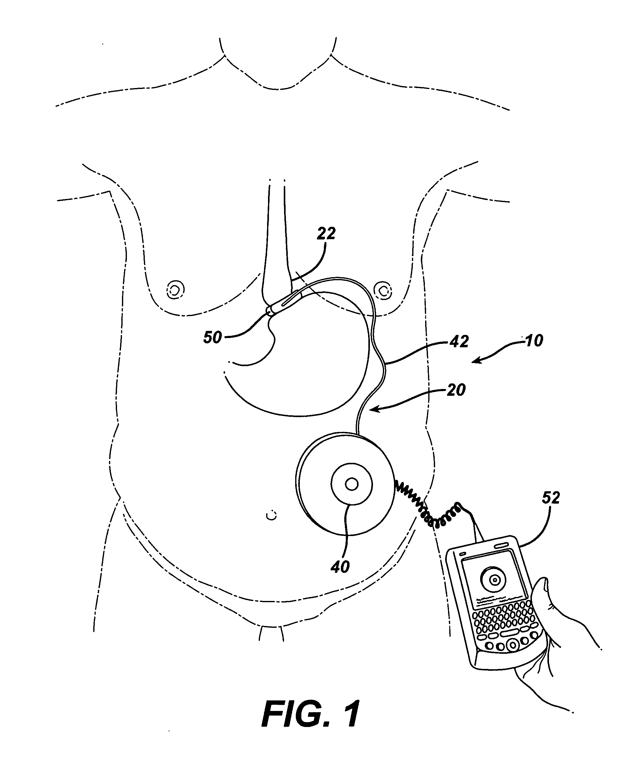 Thermodynamically driven reversible infuser pump for use as a remotely controlled gastric band