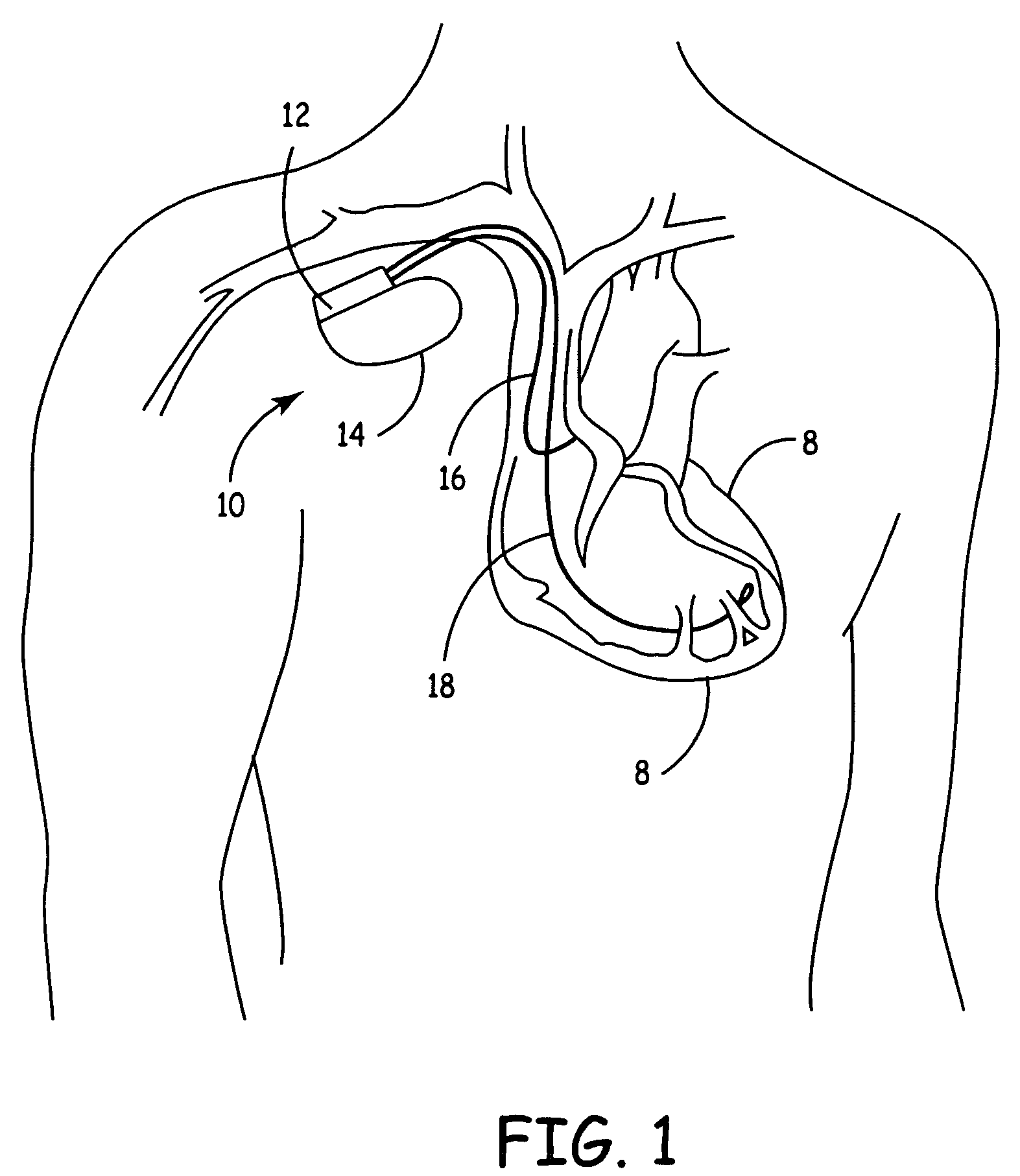 T-wave alternans train spotter