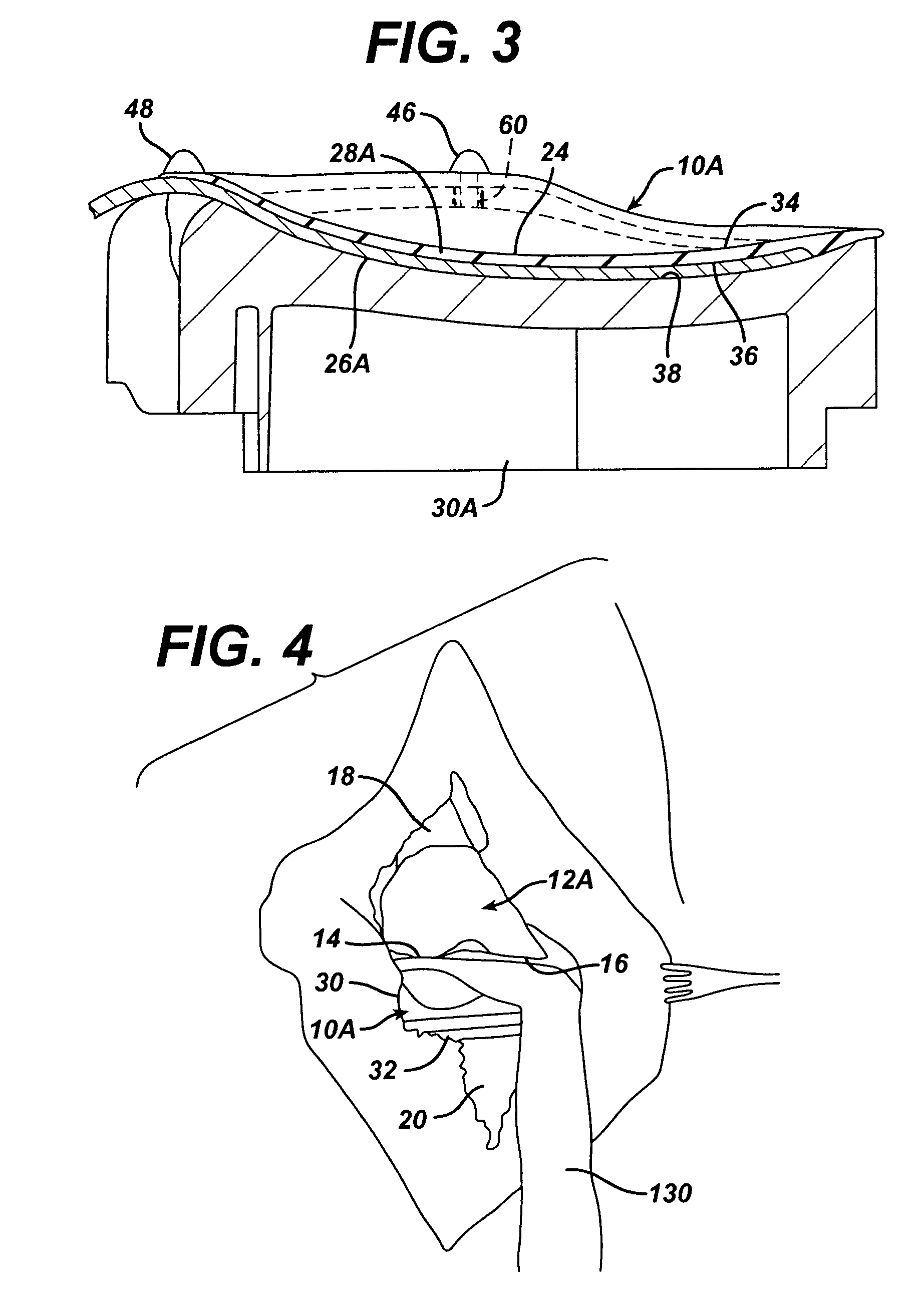 Modified system and method for intraoperative tension assessment during joint arthroplasty