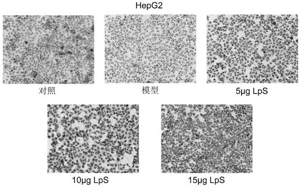 Application of lactic acid bacteria to preparing tumor prevention and treatment functional products by interfering lipid metabolism disorder