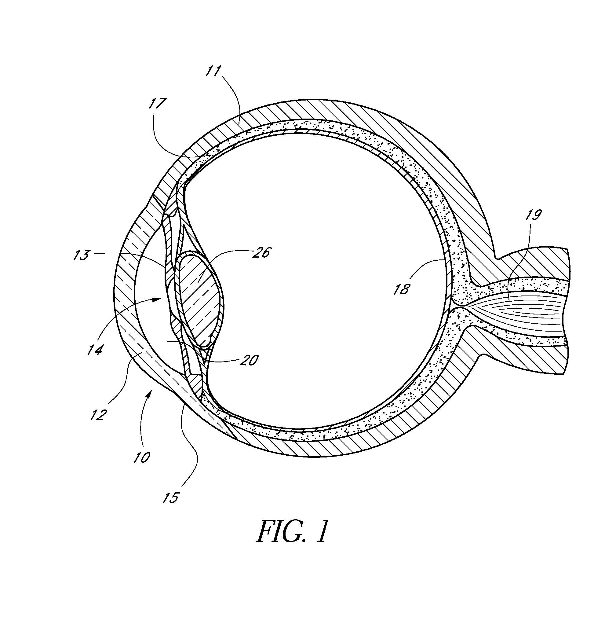 Ocular disorder treatment implants with multiple opening