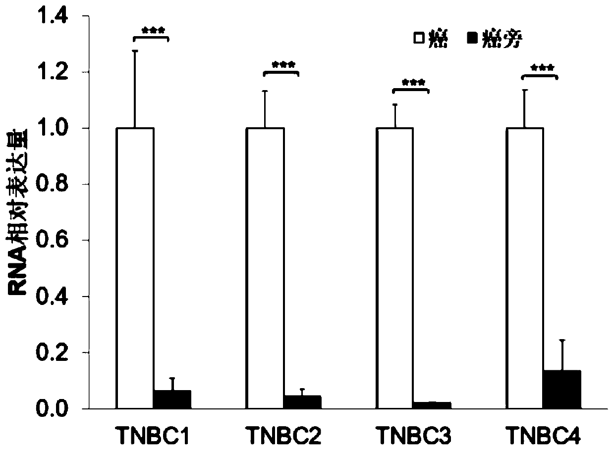 Application of yy1 expression inhibitor in preparation of medicament for breast cancer