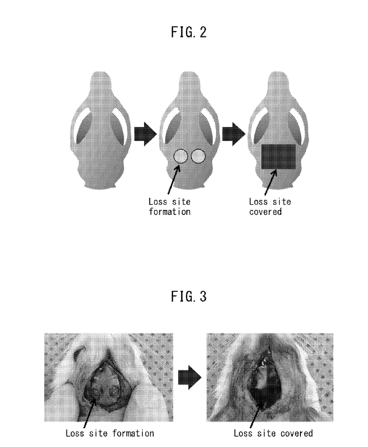 Implant and kit for treatment of bone lesion site, as well as method for treating bone lesion site