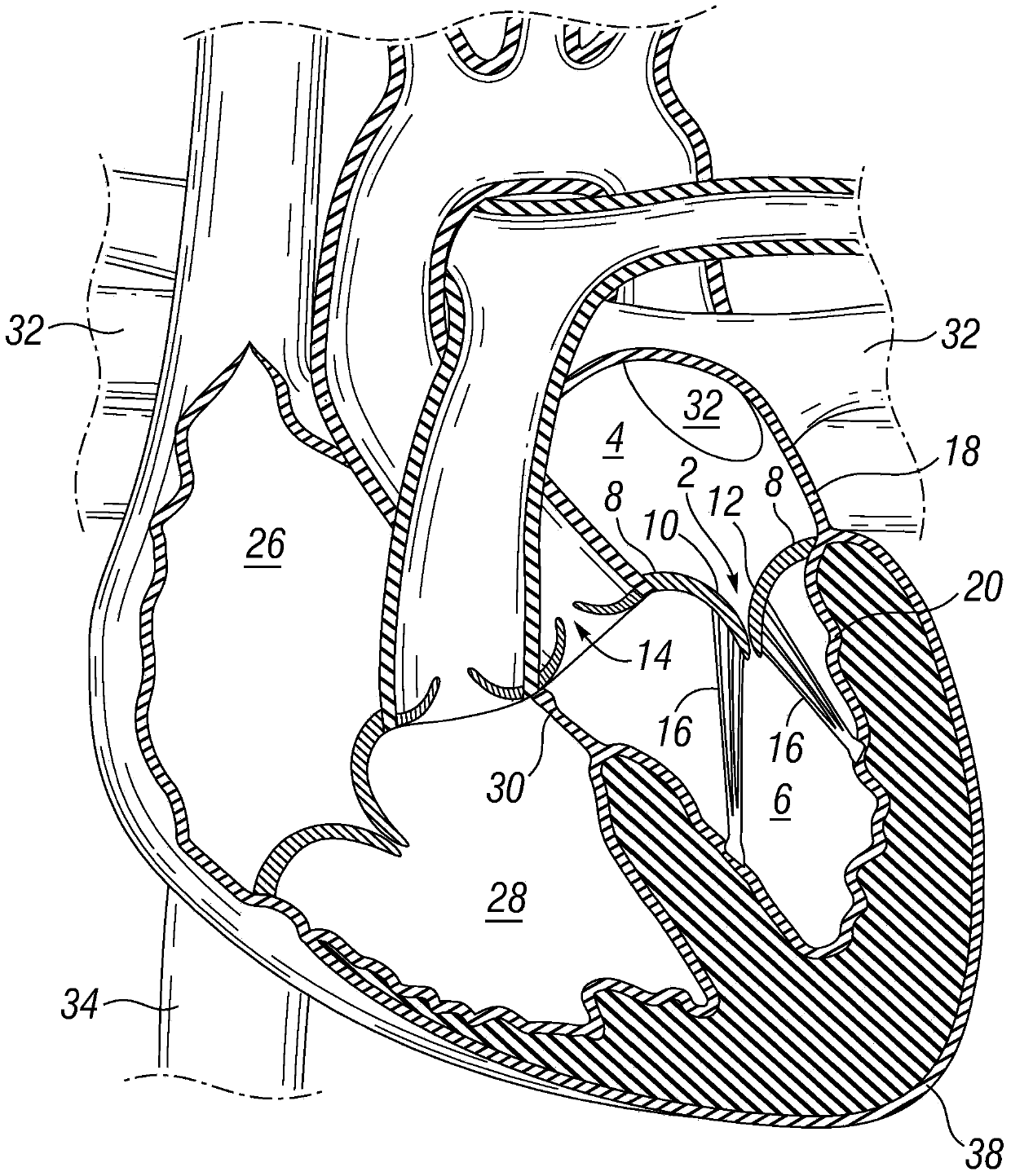 Prosthetic valve for replacing mitral valve