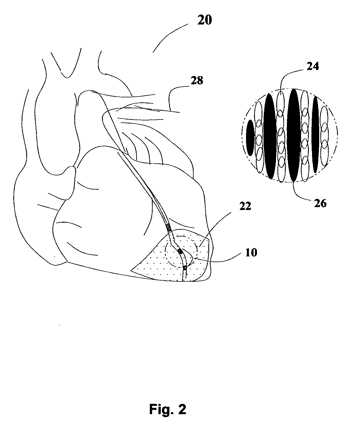 Methods and apparatus for in vivo cell therapy