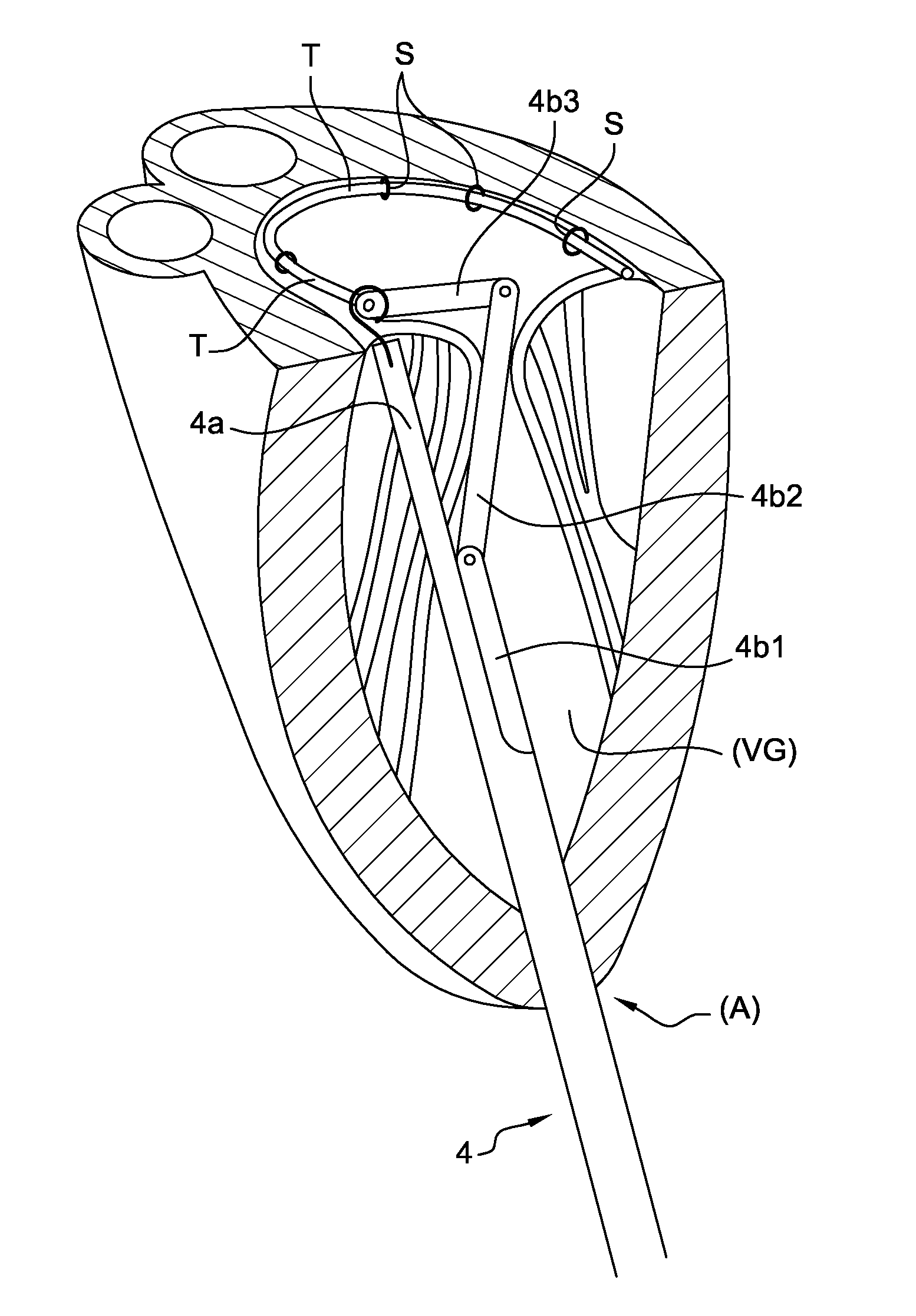 Device For Carrying Out A Transapical Mitral Valve Annuloplasty