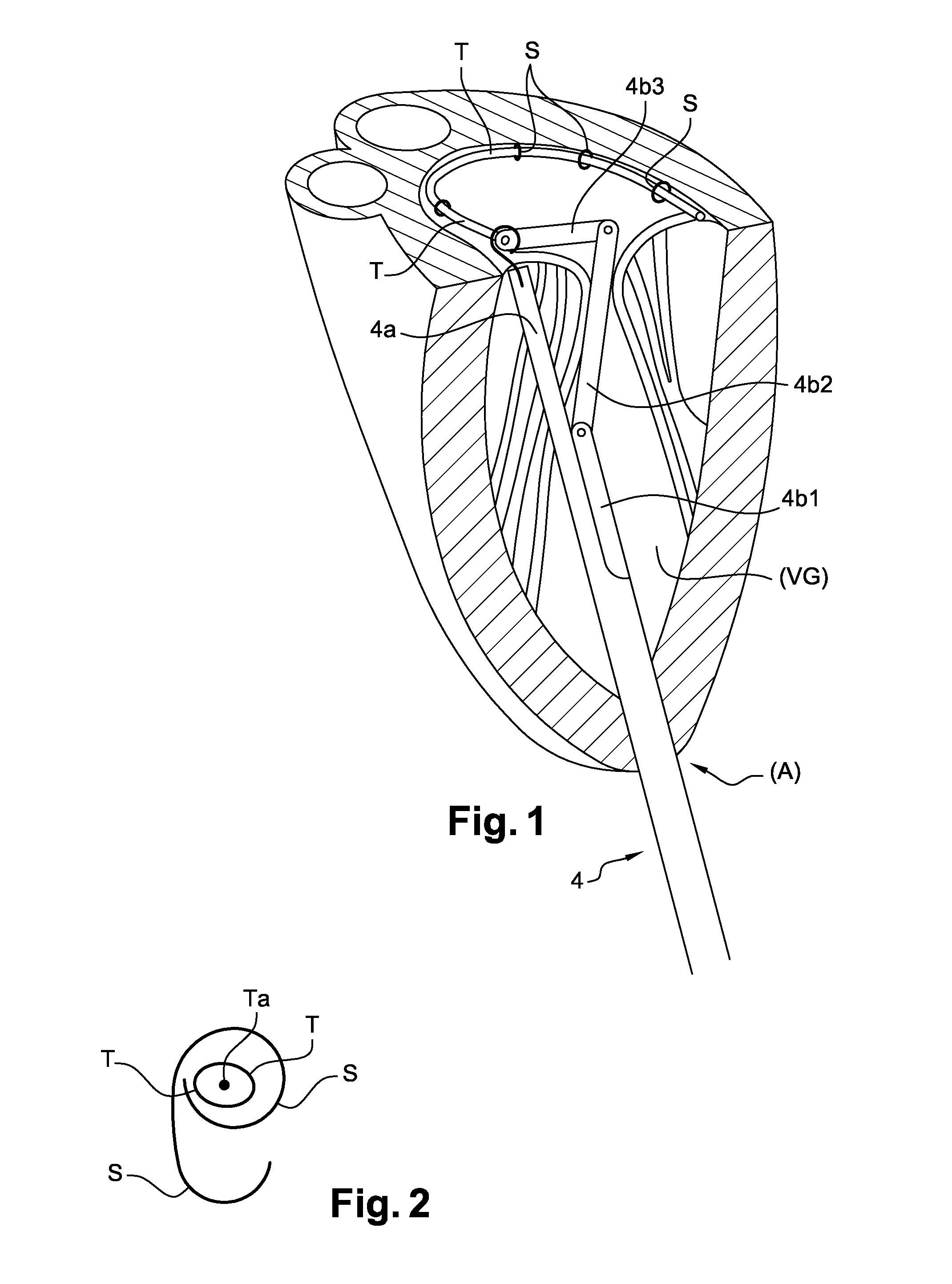 Device For Carrying Out A Transapical Mitral Valve Annuloplasty