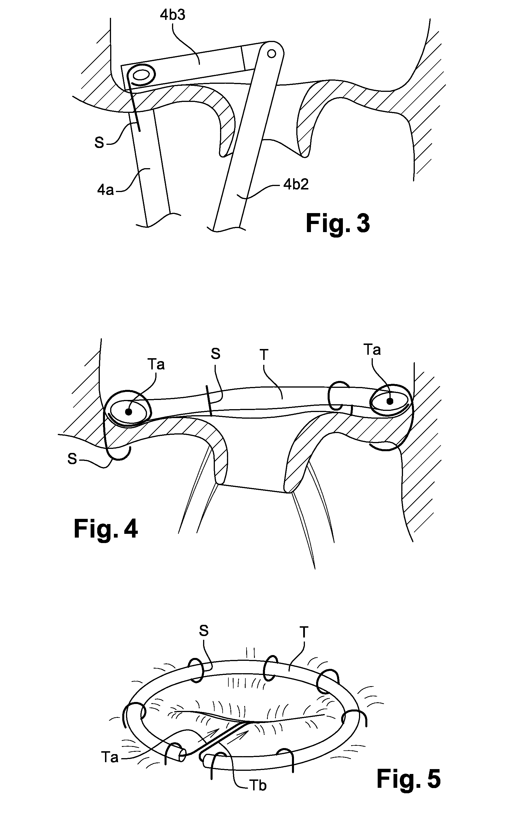 Device For Carrying Out A Transapical Mitral Valve Annuloplasty