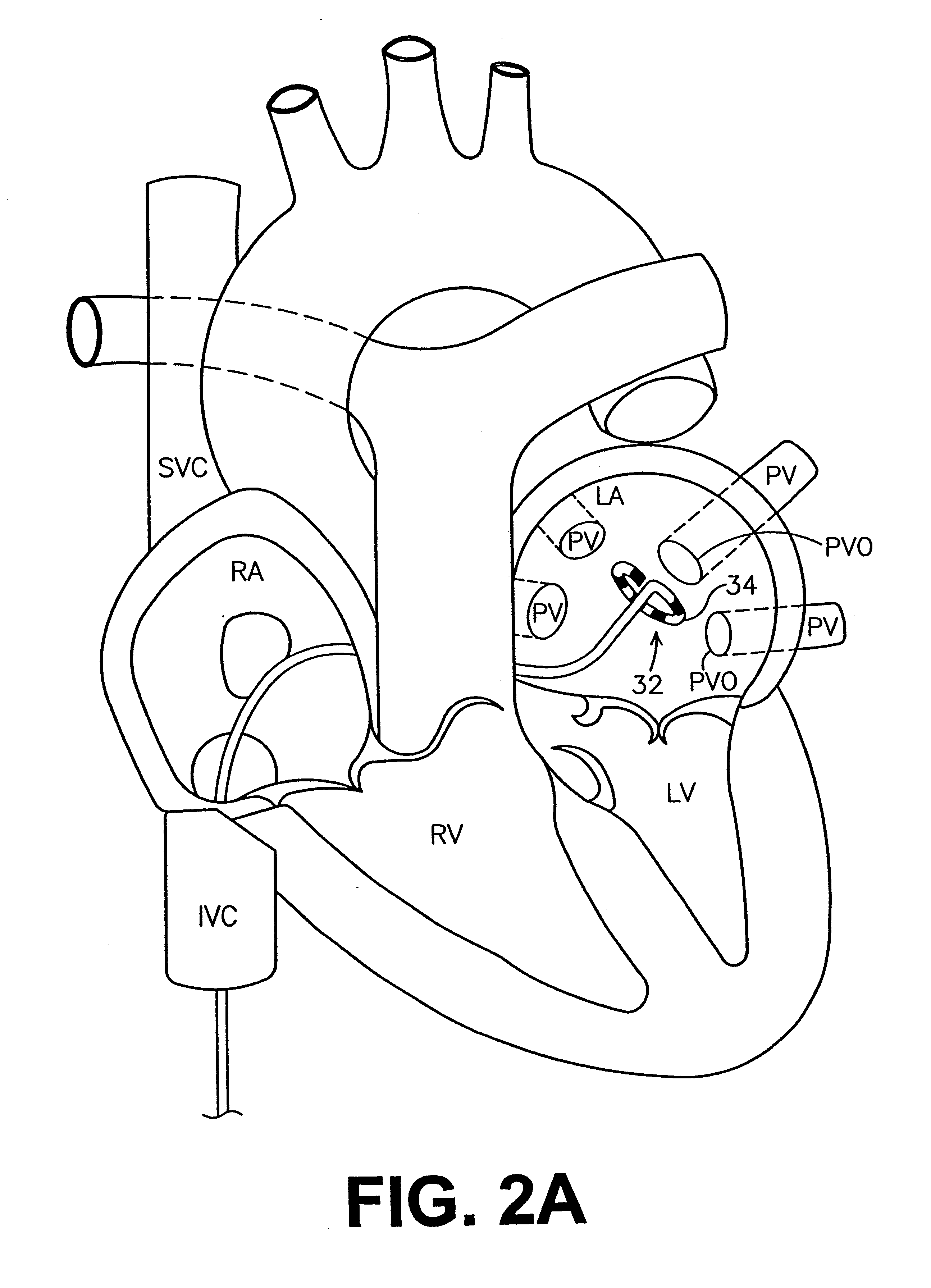 Ablation catheter and method for isolating a pulmonary vein