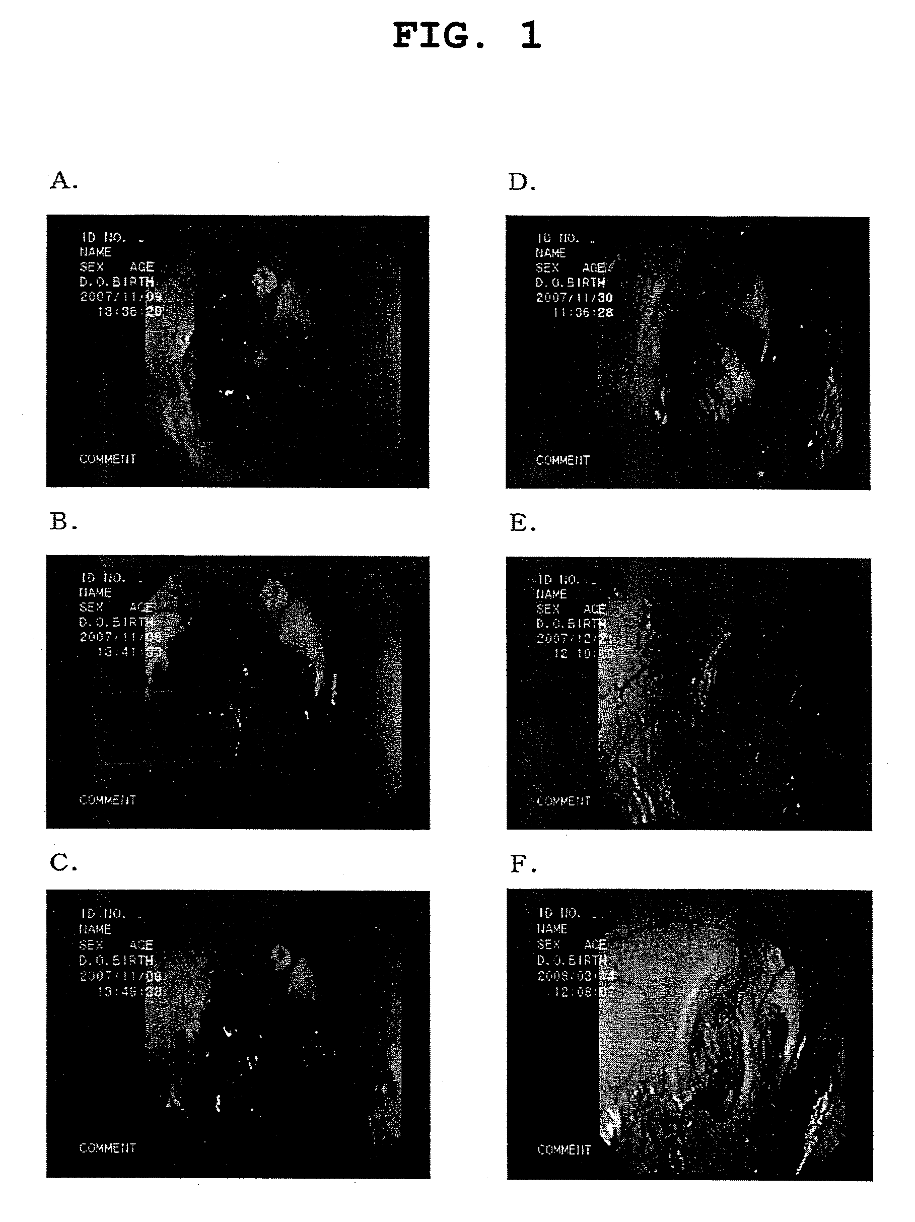 Agent for regenerating tympanic membrane or external auditory canal